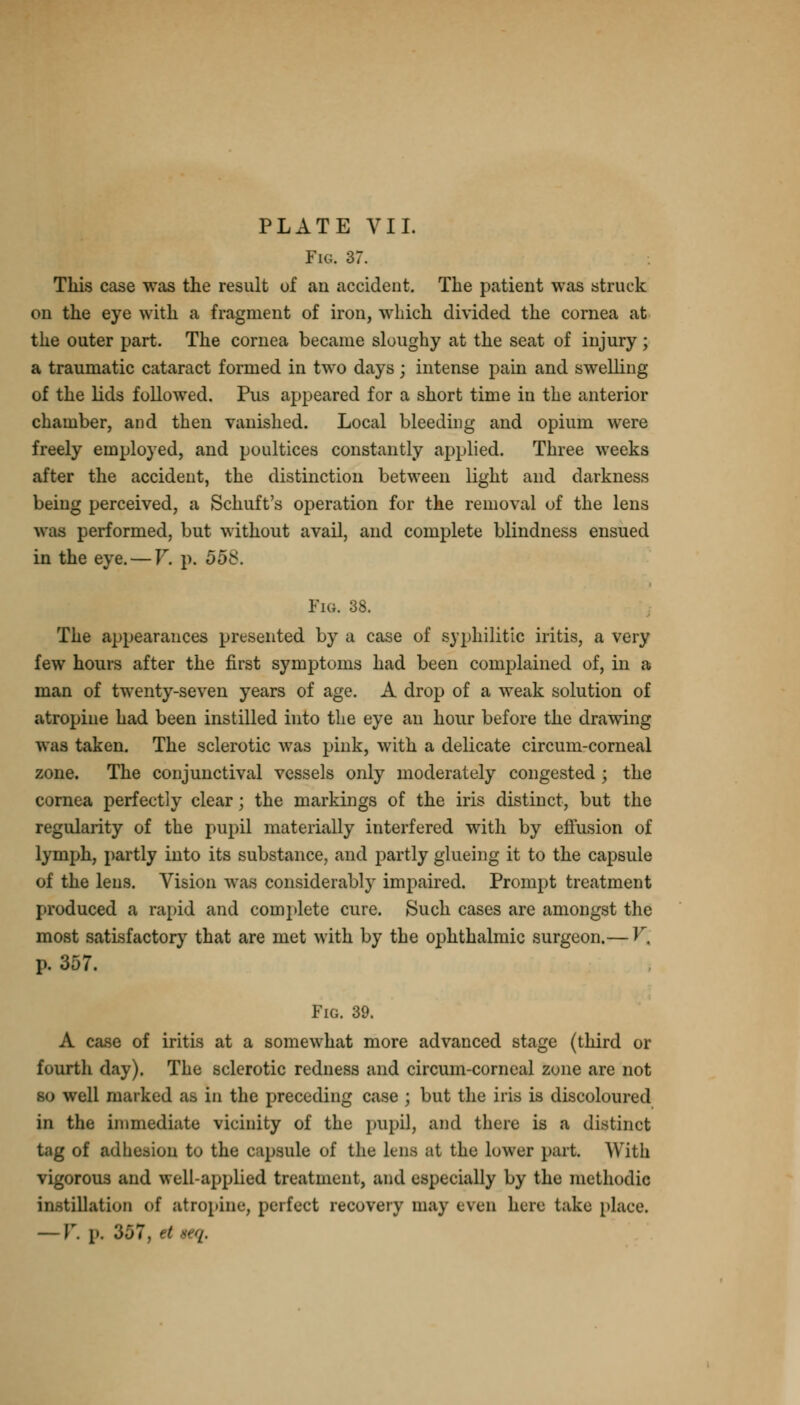 Fig. 37. This case was the result of an accident. The patient was struck on the eye with a fragment of iron, which divided the cornea at the outer part. The cornea became sloughy at the seat of injury; a traumatic cataract formed in two days j intense pain and swelling of the lids followed. Pus appeared for a short time in the anterior chamber, and then vanished. Local bleeding and opium were freely employed, and poultices constantly applied. Three weeks after the accident, the distinction between light and darkness being perceived, a Schuft's operation for the removal of the lens was performed, but without avail, and complete blindness ensued in the eye. — V. p. 55$. Fig. 38. The appearances presented by a case of syphilitic iritis, a very few hours after the first symptoms had been complained of, in a man of twenty-seven years of age. A drop of a weak solution of atropine had been instilled into the eye an hour before the drawing was taken. The sclerotic was pink, with a delicate circum-corneal zone. The conjunctival vessels only moderately congested ; the cornea perfectly clear; the markings of the iris distinct, but the regularity of the pupil materially interfered with by effusion of lymph, partly into its substance, and partly glueing it to the capsule of the lens. Vision was considerably impaired. Prompt treatment produced a rapid and complete cure. Such cases are amongst the most satisfactory that are met with by the ophthalmic surgeon.— V. p. 357. Fig. 39. A case of iritis at a somewhat more advanced stage (third or fourth day). The sclerotic redness and circum-corneal zone are not ell marked a.^, in the preceding case ; but the iris is discoloured in the immediate vieinity of the pupil, and there is a distinct tag of adhesion to the capsule of the lens at the lower part. With vigorous and well-applied treatment, and especially by the methodic instillation of atropine, perfect recovery may even here take place.