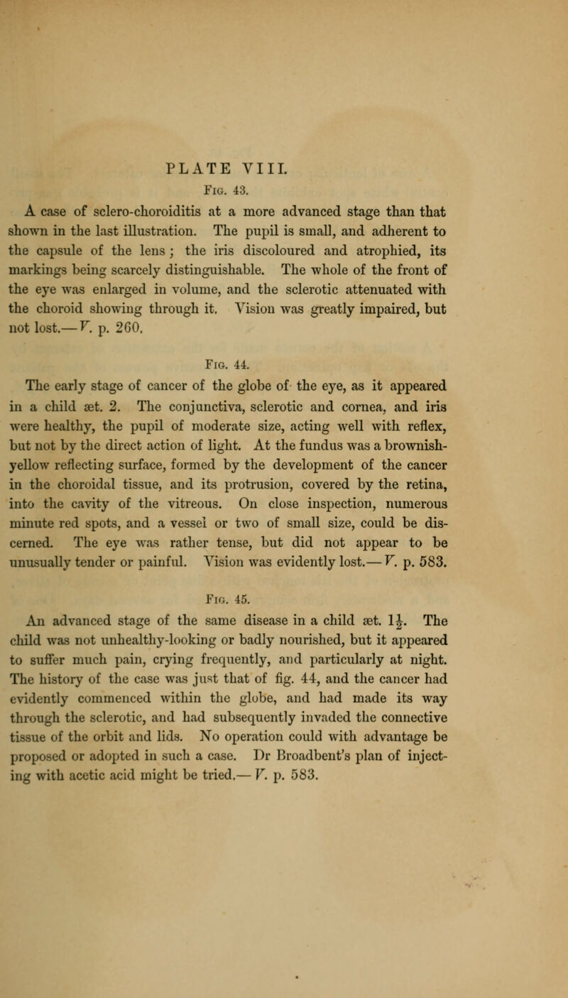 Fig. 43. A case of sclero-choroiditis at a more advanced stage than that shown in the last illustration. The pupil is small, and adherent to the capsule of the lens ; the iris discoloured and atrophied, its markings being scarcely distinguishable. The whole of the front of the eye was enlarged in volume, and the sclerotic attenuated with the choroid showing through it. Vision was greatly impaired, but not lost.— V. p. 260. Fig. 44. The early stage of cancer of the globe of the eye, as it appeared in a child set. 2. The conjunctiva, sclerotic and cornea, and iris were healthy, the pupil of moderate size, acting well with reflex, but not by the direct action of light. At the fundus was a brownish- yellow reflecting surface, formed by the development of the cancer in the choroidal tissue, and its protrusion, covered by the retina, into the cavity of the vitreous. On close inspection, numerous minute red spots, and a vessel or two of small size, could be dis- cerned. The eye was rather tense, but did not appear to be unusually tender or painful. Vision was evidently lost.— V. p. 583. Fig. 45. An advanced stage of the same disease in a child set. 1 J. The child was not unhealthy-looking or badly nourished, but it appeared to suffer much pain, crying frequently, and particularly at night. The history of the case was just that of fig. 44, and the cancer had evidently commenced within the globe, and had made its way through the sclerotic, and had subsequently invaded the connective tissue of the orbit and lids. No operation could with advantage be proposed or adopted in such a case. Dr Broadbent's plan of inject- ing with acetic acid might be tried.— V. p. 583.