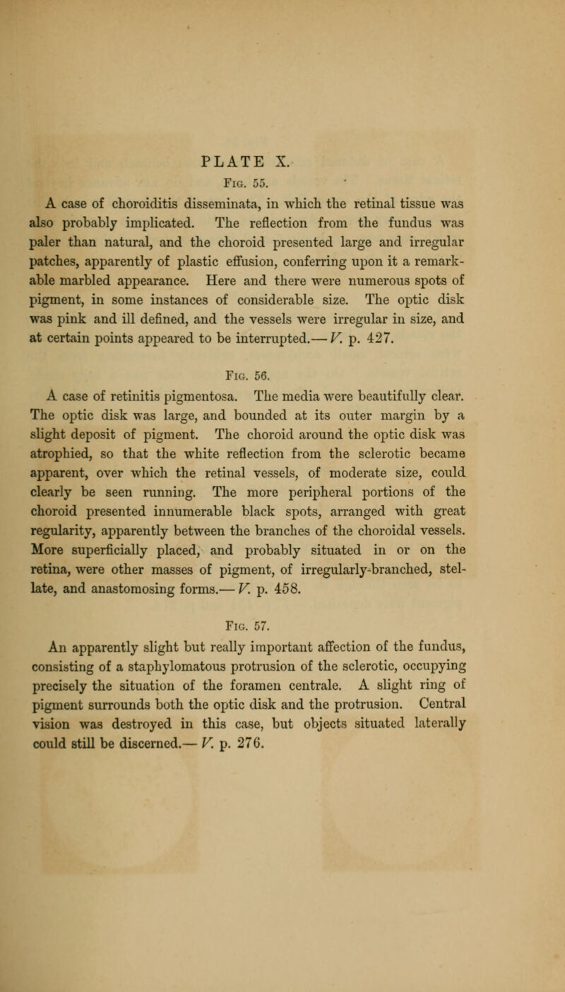 Fig. 55. A case of choroiditis disseminata, in which the retinal tissue was also probably implicated. The reflection from the fundus was paler than natural, and the choroid presented large and irregular patches, apparently of plastic effusion, conferring upon it a remark- able marbled appearance. Here and there were numerous spots of pigment, in some instances of considerable size. The optic disk was pink and ill defined, and the vessels were irregular in size, and at certain points appeared to be interrupted.— V. p. 427. Fig. 56. A case of retinitis pigmentosa. The media were beautifully clear. The optic disk was large, and bounded at its outer margin by a slight deposit of pigment. The choroid around the optic disk was atrophied, so that the white reflection from the sclerotic became apparent, over which the retinal vessels, of moderate size, could clearly be seen running. The more peripheral portions of the choroid presented innumerable black spots, arranged with great regularity, apparently between the branches of the choroidal vessels. More superficially placed, and probably situated in or on the retina, were other masses of pigment, of irregularly-branched, stel- late, and anastomosing forms.— V. p. 458. Fig. 57. An apparently slight but really important affection of the fundus, consisting of a staphylomatous protrusion of the sclerotic, occupying precisely the situation of the foramen centrale. A slight ring of pigment surrounds both the optic disk and the protrusion. Central vision was destroyed in this case, but objects situated laterally could still be discerned.— V. p. 276.