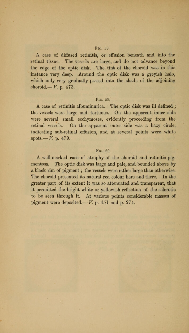 Fig. 58. A case of diffused retinitis, or effusion beneath and into the retinal tissue. The vessels are large, and do not advance beyond the edge of the optic disk. The tint of the choroid was in this instance very deep. Around the optic disk was a greyish halo, which only very gradually passed into the shade of the adjoining choroid.— V. p. 473. Fig. 59. A case of retinitis albuminuric^ The optic disk was ill denned ; the vessels were large and tortuous. On the apparent inner side were several small ecchymoses, evidently proceeding from the retinal vessels. On the apparent outer side was a hazy circle, indicating sub-retinal effusion, and at several points were white spots.— V. p. 479. Fig. 60. A well-marked case of atrophy of the choroid and retinitis pig- mentosa. The optic disk was large and pale, and bounded above by a black rim of pigment; the vessels were rather large than otherwise. The choroid presented its natural red colour here and there. In the greater part of its extent it was so attenuated and transparent, that it permitted the bright white or yellowish reflection of the sclerotic to be seen through it. At various points considerable masses of pigment were deposited.— V. p. 451 and p. 274.