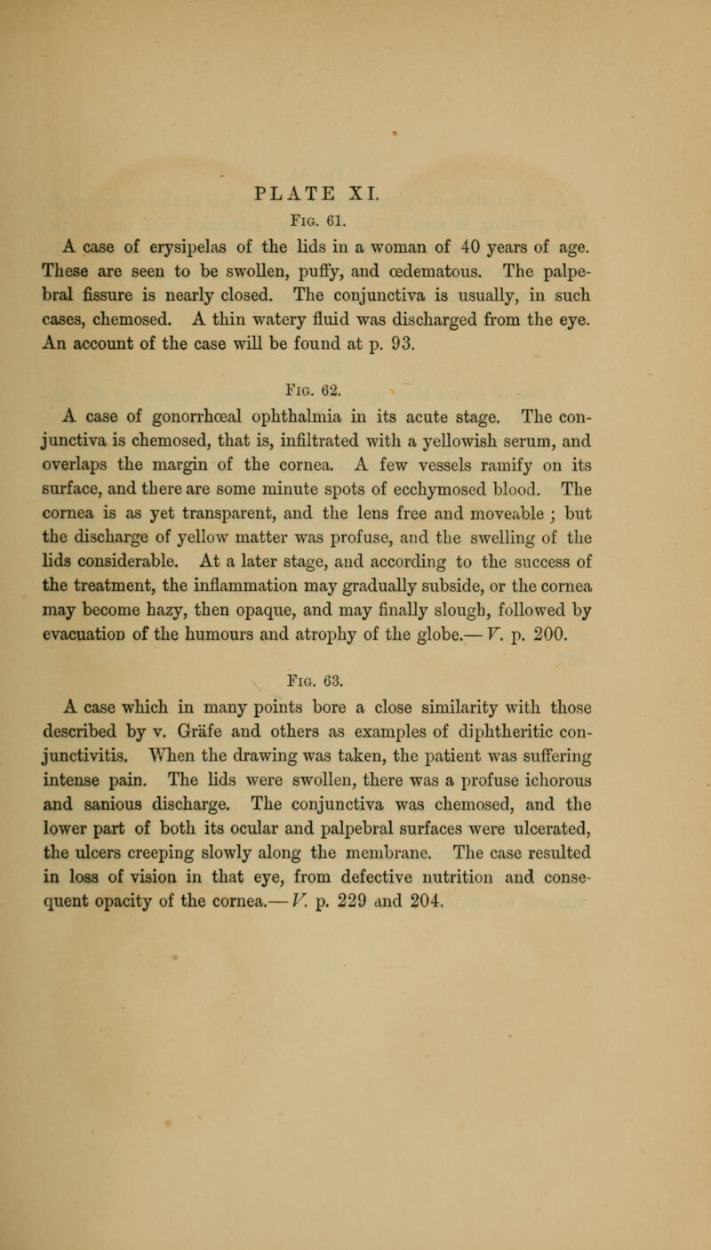 Fig. 61. A case of erysipelas of the lids in a woman of 40 years of age. These are seen to be swollen, puffy, and oedematous. The palpe- bral fissure is nearly closed. The conjunctiva is usually, in such cases, chemosed. A thin watery fluid was discharged from the eye. An account of the case will be found at p. 93. Fig. 62. A case of gonorrhceal ophthalmia in its acute stage. The con- junctiva is chemosed, that is, infiltrated with a yellowish serum, and overlaps the margin of the cornea. A few vessels ramify on its surface, and there are some minute spots of ecchymosed blood. The cornea is as yet transparent, and the lens free and moveable ; but the discharge of yellow matter was profuse, and the swelling of the lids considerable. At a later stage, and according to the success of the treatment, the inflammation may gradually subside, or the cornea may become hazy, then opaque, and may finally slough, followed by evacuation of the humours and atrophy of the globe.— V. p. 200. Fig. 63. A case which in many points bore a close similarity with those described by v. Grafe and others as examples of diphtheritic con- junctivitis. When the drawing was taken, the patient was suffering intense pain. The lids were swollen, there was a profuse ichorous and sanious discharge. The conjunctiva was chemosed, and the lower part of both its ocular and palpebral surfaces were ulcerated, the ulcers creeping slowly along the membrane. The case resulted in loss of vision in that eye, from defective nutrition and conse- quent opacity of the cornea.— V. p. 229 and 204.