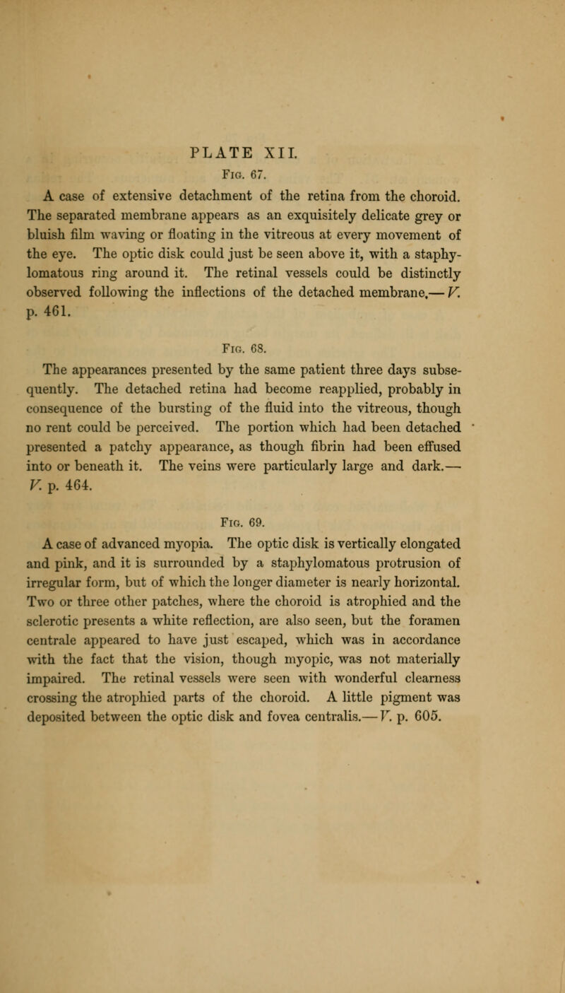 Fig. 67. A case of extensive detachment of the retina from the choroid. The separated membrane appears as an exquisitely delicate grey or bluish film waving or floating in the vitreous at every movement of the eye. The optic disk could just be seen above it, with a staphy- lomatous ring around it. The retinal vessels could be distinctly observed following the inflections of the detached membrane,— V. p. 461. Fig. 68. The appearances presented by the same patient three days subse- quently. The detached retina had become reapplied, probably in consequence of the bursting of the fluid into the vitreous, though no rent could be perceived. The portion which had been detached presented a patchy appearance, as though fibrin had been effused into or beneath it. The veins were particularly large and dark.— V. p. 464. Fig. 69. A case of advanced myopia. The optic disk is vertically elongated and pink, and it is surrounded by a staphylomatous protrusion of irregular form, but of which the longer diameter is nearly horizontal. Two or three other patches, where the choroid is atrophied and the sclerotic presents a white reflection, are also seen, but the foramen centrale appeared to have just escaped, which was in accordance with the fact that the vision, though myopic, was not materially impaired. The retinal vessels were seen with wonderful clearness crossing the atrophied parts of the choroid. A little pigment was deposited between the optic disk and fovea centralis.— V. p. 605.