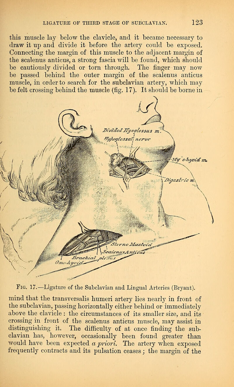 this muscle lay below the clavicle, and it became necessary to draw it up and divide it before the artery could be exposed. Connecting the margin of this muscle to the adjacent margin of the scalenus anticus, a strong fascia will be found, which should be cautiously divided or torn through. The finger may now be passed behind the outer margin of the scalenus anticus muscle, in order to search for the subclavian artery, which may be felt crossing behind the muscle (fig. 17). It should be borne in -My o-hyoidffi, Fig. 17.—Ligature of the Subclavian and Lingual Arteries (Bryant). mind that the transversalis humeri artery lies nearly in front of the subclavian, passing horizontally either behind or immediately above the clavicle : the circumstances of its smaller size, and its crossing in front of the scalenus anticus muscle, may assist in distinguishing it. The difficulty of at once finding the sub- clavian has, however, occasionally been found greater than would have been expected a priori. The artery when exposed frequently contracts and its' pulsation ceases ; the margin of the