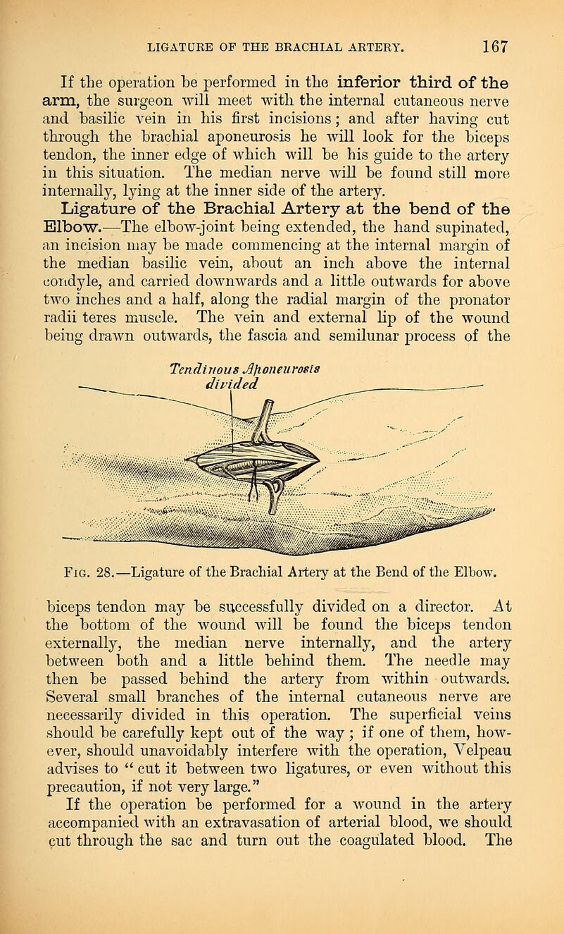 If the operation be performed in the inferior third of the arm, the surgeon will meet with the internal cutaneous nerve and basilic vein in his first incisions; and after having cut through the brachial aponeurosis he will look for the biceps tendon, the inner edge of which will be his guide to the artery in this situation. The median nerve will be found still more internally, lying at the inner side of the artery. Ligature of the Brachial Artery at the bend of the Elbow.—The elbow-joint being extended, the hand supinated, an incision may be made commencing at the internal margin of the median basilic vein, about an inch above the internal condyle, and carried downwards and a little outwards for above two inches and a half, along the radial margin of the pronator radii teres muscle. The vein and external Up of the wound being drawn outwards, the fascia and semilunar process of the Tendinous Aponeurosis — divided Fig. 28.—Ligature of the Brachial Artery at the Bend of the Elbow. biceps tendon may be successfully divided on a director. At the bottom of the wound will be found the biceps tendon externally, the median nerve internally, and the artery between both and a little behind them. The needle may then be passed behind the artery from within outwards. Several small branches of the internal cutaneous nerve are necessarily divided in this operation. The superficial veins should be carefully kept out of the way; if one of them, how- ever, should unavoidably interfere with the operation, Yelpeau advises to  cut it between two ligatures, or even without this precaution, if not very large. If the operation be performed for a wound in the artery accompanied with an extravasation of arterial blood, we should cut through the sac and turn out the coagulated blood. The