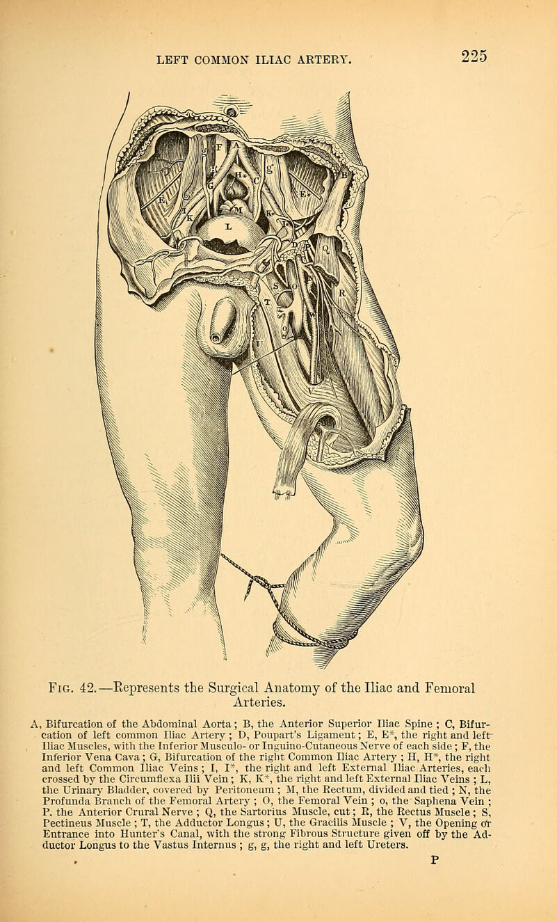 Fig. 42. —Kepresents the Surgical Anatomy of the Iliac and Femoral Arteries. A, Bifurcation of the Abdominal Aorta; B, the Anterior Superior Iliac Spine ; C, Bifur- cation of left common Iliac Artery ; D, Poupart's Ligament; E, E*, the right and left- Iliac Muscles, with the Inferior Musculo- or Inguino-Cutaneous Nerve of each side; F, the Inferior Vena Cava; G, Bifurcation of the right Common Iliac Artery ; H, H*, the right and left Common Iliac Veins; I, I*, the right and left External Iliac Arteries, each crossed by the Circumflexa Ilii Vein; K, K*, the right and left External Iliac Veins ; L, the Urinary Bladder, covered by Peritoneum ; M, the Rectum, divided and tied ; N, the Profunda Branch of the Femoral Artery ; 0, the Femoral Vein ; o, the Saphena Vein ; P. the Anterior Crural Nerve ; Q, the Sartorius Muscle, cut; R, the Rectus Muscle ; S, Pectineus Muscle ; T, the Adductor Longus ; U, the Gracilis Muscle ; V, the Opening ot Entrance into Hunter's Canal, with the strong Fibrous Structure given off by the Ad- ductor Longus to the Vastus Internus ; g, g, the right and left Ureters.