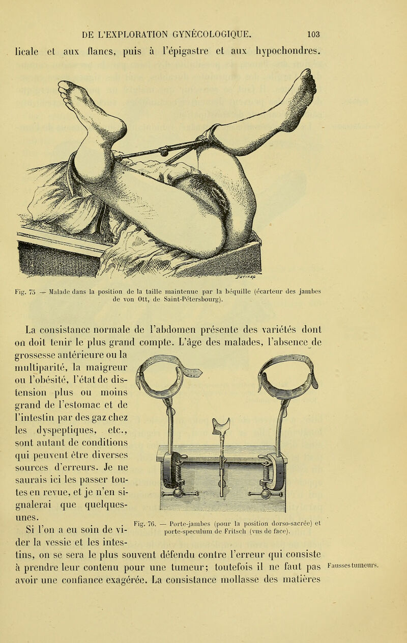 licale et aux flancs, puis à l'épigastre et aux hypochondres. Fiff. 75 — Malade dans la position de la taille maintenue par la béquille (écartëur des jambes de von Ott, de Saint-Pétersbourg). La consistance normale de l'abdomen présente des variétés dont on doit tenir le plus grand compte. L'âge des malades, l'absencede grossesse antérieure ou la multiparité, la maigreur ou l'obésité, l'état de dis- tension plus ou moins grand de l'estomac et de l'intestin par des gaz chez les dyspeptiques, etc., sont autant de conditions qui peinent être diverses sources d'erreurs. Je ne saurais ici les passer tou- tes en revue, et je n'en si- gnalerai que quelques- unes. Si l'on a eu soin de vi- Fie. 76. — Porte-jambes (pour la position dorso-sacrée) et porte-speculum de Fritsch (vus de face). der la vessie et les intes- tins, on se sera le plus souvent défendu contre l'erreur qui consiste à prendre leur contenu pour une tumeur; toutefois il ne faut pas Faussestumeun avoir une confiance exagérée. La consistance mollasse des matières