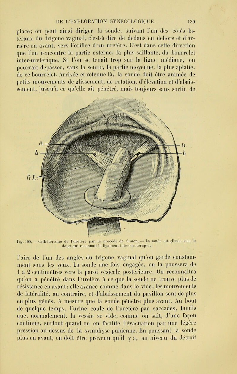 place; on peut ainsi diriger la sonde, suivant l'un des côtés la- téraux du tiïgonc vaginal, c'est-à dire de dedans en dehors et d'ar- rière en avant, vers l'orifice d'un uretère. C'est dans cette direction que l'on rencontre la partie externe, la plus saillante, du bourrelet inter-uretérique. Si l'on se tenait trop sur la ligne médiane, on pourrait dépasser, sans la sentir, la partie moyenne, la plus aplatie, de ce bourrelet. Arrivée et retenue là, la sonde doit être animée de petits mouvements de glissement, de rotation, d'élévation et d'abais- sement, jusqu'à ce qu'elle ait pénétré, mais toujours sans sortir de Fig. 100. — Calliétérisme de l'uretère par le procédé de Simon. — La sonde est glissée sous le doigt qui reconnaît le ligament inter-uretérique. l'aire de l'un des angles du trigone vaginal qu'on garde constam- ment sous les yeux. La sonde une fois engagée, on la poussera de 1 à 2 centimètres vers la paroi vésicale postérieure. On reconnaîtra qu'on a pénétré dans l'uretère à ce que la sonde ne trouve plus de résistance en avant; elle avance comme dans le vide; les mouvements de latéralité, au contraire, et d'abaissement du pavillon sont de plus en plus gênés, à mesure que la sonde pénètre plus avant. Au bout de quelque temps, l'urine coule de l'uretère par saccades, tandis que, normalement, la vessie se vide, comme on sait, d'une façon continue, surtout quand on en facilite l'évacuation par une légère pression au-dessus de la symphyse pubienne. En poussant la sonde plus en avant, on doit être prévenu qu'il y a, au niveau du détroit