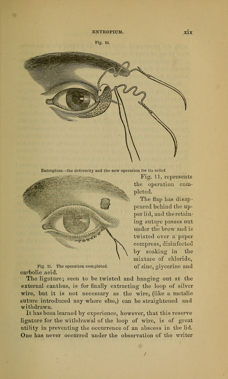 EKTROPIUM. Fig. 10. XIX Entropium—the deformity and the new operation for its relief. Fig. 11, represents the operation com- pleted. The flap has disap- peared behind the up- per lid, and the retain- ing suture passes out under the brow and is twisted over a paper compress, disinfected by soaking in the mixture of chloride, Fig. 11. The operation completed. of zillC, glycerine and carbolic acid. The ligature; seen to be twisted and hanging out at the external canthus, is for finally extracting the loop of silver wire, but it is not necessary as the wire, (like a metalic suture introduced any where else,) can be straightened and withdrawn. It has been learned by experience, however, that this reserve ligature for the withdrawal of the looj) of wire, is of great utility in preventing the occurrence of an abscess in the lid. One has never occurred under the observation of the writer