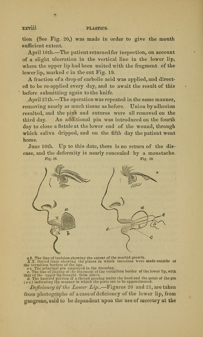 tion (See Fig. 20,) was made in order to give the mouth sufficient extent. April 16th.—The patient returned for inspection, on account of a slight ulceration in the vertical line in the lower lip, where the upper lip had been united with the fragment of the lower lip, marked c in the cut Fig. 19. A fraction of a drop of carbolic acid was applied, and direct- ed to be re-applied every day? and to await the result of this before submitting again to the knife. April 27th.—The operation was repeated in the same manner, removing nearly as much tissue as before. Union by adhesion resulted, and the pins and sutures were all removed on the third day. An additional pin was introduced on the fourth day to close afistuleat the lower end of the wound, through which saliva dripped, and on the fifth day the patient went home. June 10th. Up to this date, there is no return of the dis- ease, and the deformity is nearly concealed by a moustache. Fig. 18. Fig. 19. a b. The line of incision showing the extent of the morbid growth. XX. Dotted linos showing the places in which incisions Were made outside of the vermilion borders of the lips. e e. The principal pin employed in the dressing. c. The line of joining of the fragment of the vermilion border of the lower lip, with that of the upper lip brought from above. d. The knotted portion of a thread passing under the head and the point of the pin ( e e.) indicating the manner in which the parts are to be approximated. Deficiency of the Lower Lip..—Figures 20 and 21, are taken from photographs of a case of deficiency of the lower lip, from gangrene, said to be dependent upon the use of mercury at the