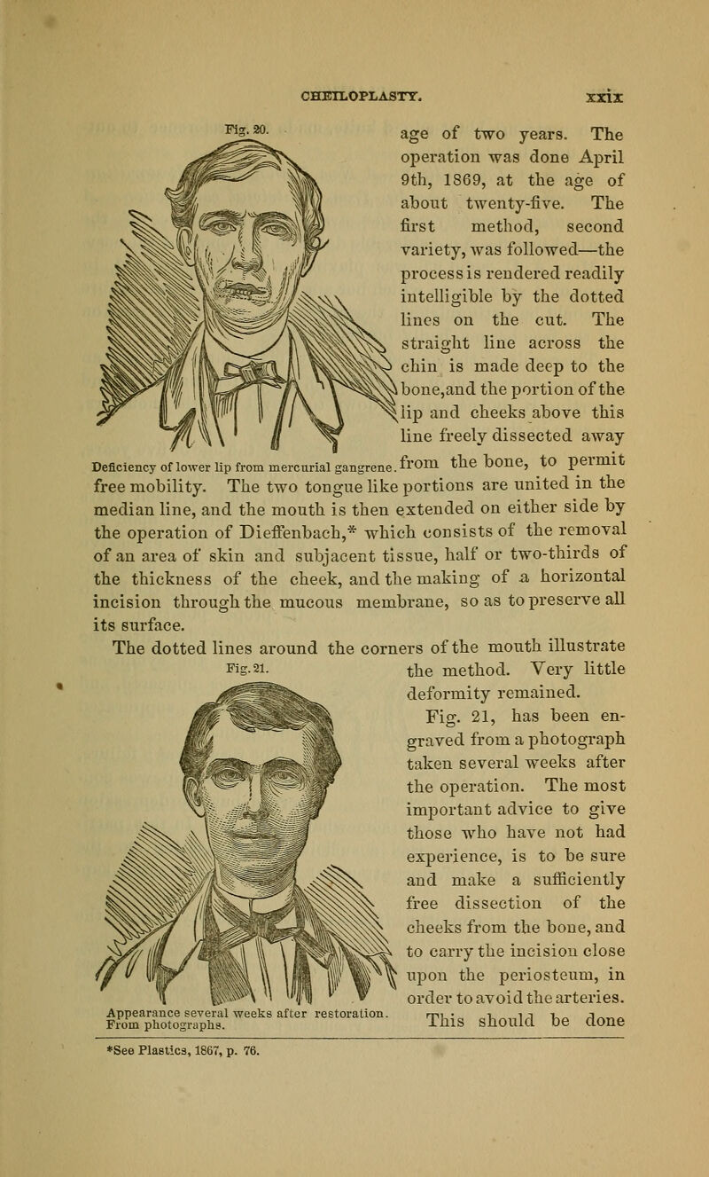 age of two years. The operation was done April 9th, 1869, at the age of about twenty-five. The first method, second variety, was followed—the process is rendered readily intelligible by the dotted lines on the cut. The straight line across the chin is made deep to the ibone,and the portion of the ;lip and cheeks above this line freely dissected away Deficiency of lower lip from mercurial gangrene, from the bone, to permit free mobility. The two tongue like portions are united in the median line, and the mouth is then extended on either side by the operation of Dieffenbach,* which consists of the removal of an area of skin and subjacent tissue, half or two-thirds of the thickness of the cheek, and the making of a horizontal incision through the mucous membrane, so as to preserve all its surface. The dotted lines around the corners of the mouth illustrate Fig. 21. the method. Very little deformity remained. Fig. 21, has been en- graved from a photograph taken several weeks after the operation. The most important advice to give those who have not had experience, is to be sure and make a sufficiently free dissection of the cheeks from the bone, and to carry the incision close upon the periosteum, in order to avoid the arteries. Appearance several weeks after restoration. mr- „i„„ij r.- A~n~ From photographs. lnis should be done