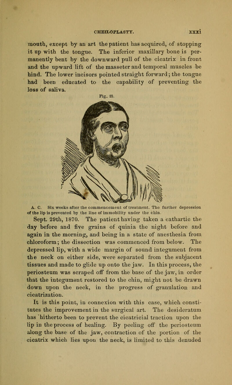 mouth, except by an art the patient has acquired, of stopping it up with the tongue. The inferior maxillary bone is per- manently bent by the downward pull of the cicati-ix in front and the upward lift of the masseter and temporal muscles be hind. The lower incisors pointed straight forward; the tongue had been educated to the capability of preventing the loss of saliva. Fig. 23. A. C. Six weeks after the commencement of treatment. The further depression of the lip is prevented by the line of immobility under the chin. Sept. 29th, 1870. The patient having taken a cathartic the day before and five grains of quinia the night before and again in the morning, and being in a state of anesthesia from chloroform; the dissection was commenced from below. The depressed lip, with a wide margin of sound integument from the neck on either side, were separated from the subjacent tissues and made to glide up onto the jaw. In this process, the periosteum was scraped off from the base of the jaw, in order that the integument restored to the chin, might not be drawn down upon the neck, in the progress of granulation and cicatrization. It is this point, in connexion with this case, which consti- tutes the improvement in the surgical art. The desideratum has hitherto been to prevent the cicatricial traction upon the lip in the process of healing. By peeling off the periosteum along the base of the jaw, contraction of the portion of the cicatrix which lies upon the neck, is limited to this denuded