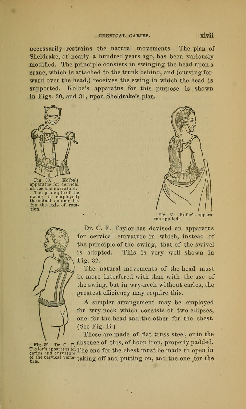 necessarily restrains the natural movements. The plan of Sheldrake, of nearly a hundred years ago, has been variously modified. The principle consists in swinging the head upon a crane, which is attached to the trunk behind, and (curving for- ward over the head,) receives the swing in which the head is supported. Kolbe's apparatus for this purpose is shown in Figs. 30, and 31, upon Sheldrake's plan. Fig. 30. Kolbe's apparatus for cervical caries and curvature. The principle of the 6wing is employed; the spinal column be- ing the axis of rota- tion. Fig. 31. Kolbe's appara- tus applied. Dr. C. F. Taylor has devised an apparatus for cervical curvature in which, instead of the principle of the swing, that of the swivel is adoj)ted. This is very well shown in Fig. 32. The natural movements of the head must be more interfered with than with the use of the swing, but in wry-neck without caries, the greatest efficiency may require this. A simpler arrangement may be employed for wry neck which consists of two ellipses, one for the head and the other for the chest. (See Fig. B.) These are made of flat truss steel, or in the absence of this, of hoop iron, properly padded. Ja^1^r,ns,1aHP^,r5i\sJorThe one for the chest must be made to open in CailCS allQ C lir v a ill PG -1- of _the cervical verte- taking off and putting on, and the one .for the Fig. 32.