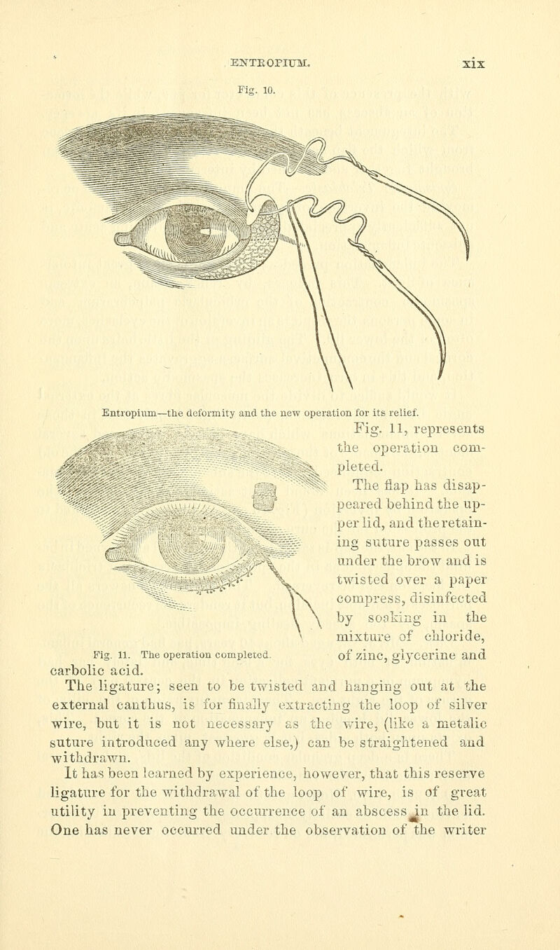 ENTE OPIUM. Fig. 10. XIX Entropiiim—the deformity and tlie new operation for its relief. Fig. 11, represents the operation com- pleted. The flap has disap- peared behind the up- per lid, and the retain- ing suture passes out under the brow and is twisted over a paper compress, disinfected by soaking in the mixture of chloride, Fig. 11. Tiie operation completed, of zinc, glycerine and carbolic acid. The ligature; seen to be twisted and hanging out at the external canthus, is for finally extracting the loop of silver wire, but it is not necessary as the wire, (like a metalic suture introduced any where else,) can be straightened and withdrawn. It has been learned by experience, however, that this reserve ligature for the withdrawal of the loop of wire, is of great utility in preventing the occurrence of an abscess Jn the lid. One has never occurred under the observation of the writer