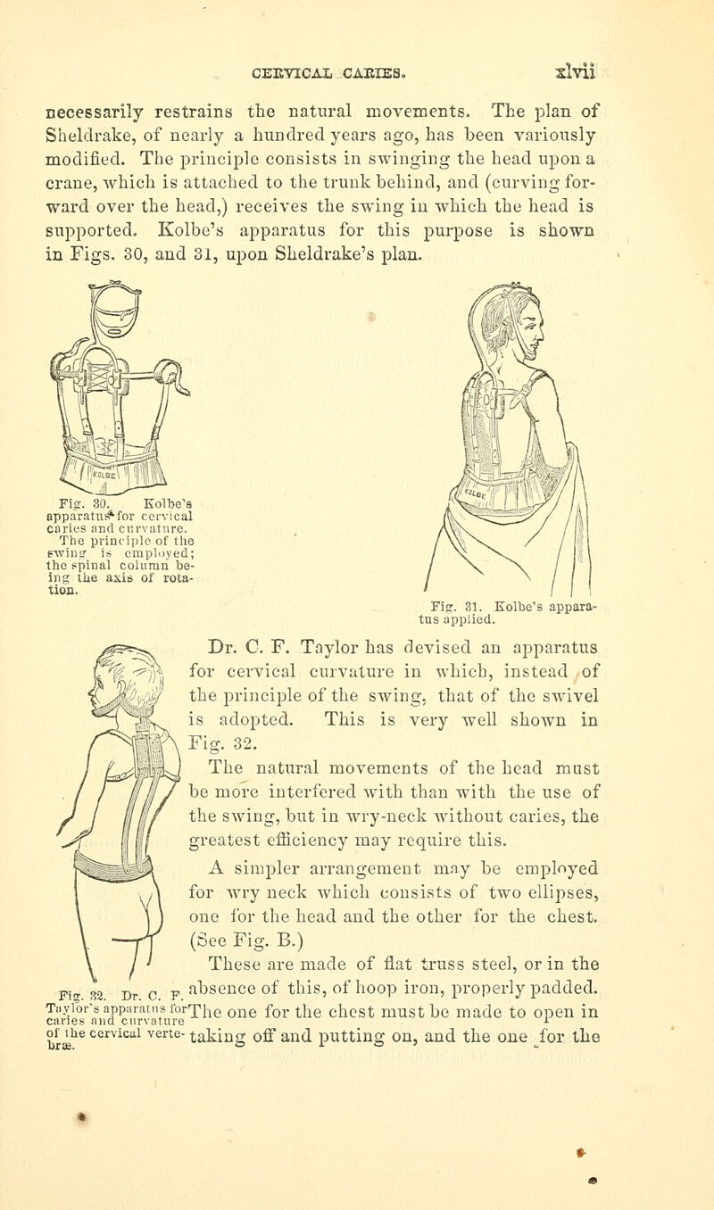 CEEVICAl CAEIES. slvii necessarily restrains the natural movements. The plan of Sheldrake, of nearly a hiinclrecl years ago, has been variously modified. The principle consists in swinging the head upon a crane, which is attached to the trunk behind, and (curving for- ward over the head,) receives the swing in which the head is supported. Kolbe's apparatus for this purpose is shown in Figs. 30, and 31, upon Sheldrake's plan. Fig. 30. Kolbe's apparatu^for cervical caries and curvature. The princijile of tlie ewiiiff is employed; the spinal column be- ing liie axis of rota- tion. Fig. 31. Kolbe's appara- tus applied. Dr. G. F. Taylor has devised an apparatus for cervical curvature in which, instead of the principle of the swing, that of the swivel is adopted. This is very well shown in Fig. 32. The natural movements of the head must be more interfered with than with the use of the swing, but in wry-neck without caries, the greatest efficiency may require this. A simpler arrangement may be employed for wry neck which consists of two ellipses, one for the head and the other for the chest. (See Fig. B.) These are made of flat truss steel, or in the Fi 32 Dr c F abscucc of this, of hoop iron, properly padded. Tuyfor-sapparainsiorThe one for the chcst must bc made to open in canes and curvature J- onhe cervical verte- taking off and putting on, and the one Jov the