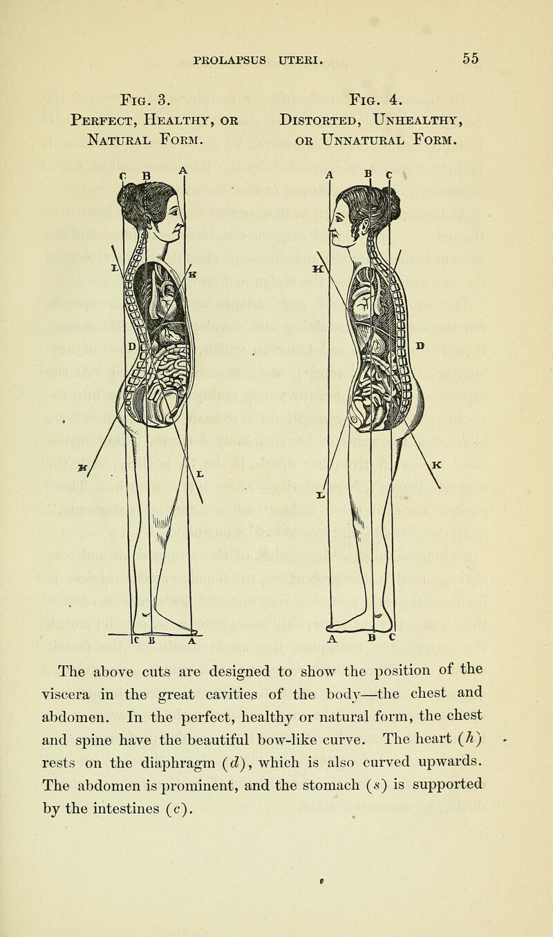 Fig. 3. Perfect, Healthy, or Natural Form. Fig. 4. Distorted, Unhealthy, OR Unnatural Form. B c The above cuts are designed to show the position of the viscera in the great cavities of the body—the chest and abdomen. In the perfect, healthy or natural form, the chest and spine have the beautiful bow-like curve. The heart (h) rests on the diaphragm (cZ), which is also curved upwards. The abdomen is prominent, and the stomach (s) is supported by the intestines (c).