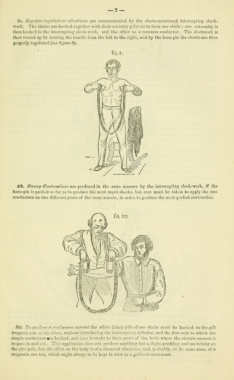 3a. Regular rmpitJscs or vibrafions are commnnieated by the abovc-racntioncd intevrnpting clock- work. The chains are hooked together with their contrary poles as to form one chain ; one extremity is then hooked to the interrupting clock-work, and the other to. a common conductor. The clockwork is then wound up by turning the handle from the left to the right, and by the horn-pin the shocks are then properly regulated (see figure 8). ih.z. 4th. Strong Contraetions are produced in the same manner by the interrupting cloek-work, if the horn-pin is pushed so far as to produce the most rapid shocks, but care must be taken to apply the two conductors on two different parts of the same muscle, in order to produce the most perfect contraction. .5th. To pr.oflnco ft sonfJnvon<; current the white (zinc) polo of one chain must be hooked to the gi!6 (copper) pole oi the other, without introducing the interrupting cylinder, and the free ends to which the simple conductors are hooked, and tlien brought to those parts of the body where the electric current is to pass in and ont. This application does not produce anything but a slight prickling and an itching on the zinc pole, but the effect on the body is of a chemical character, and, probably, t\t ihi same time, of i^ aia^etic one too, which ought always to be kept in view in a galvanic treatment.