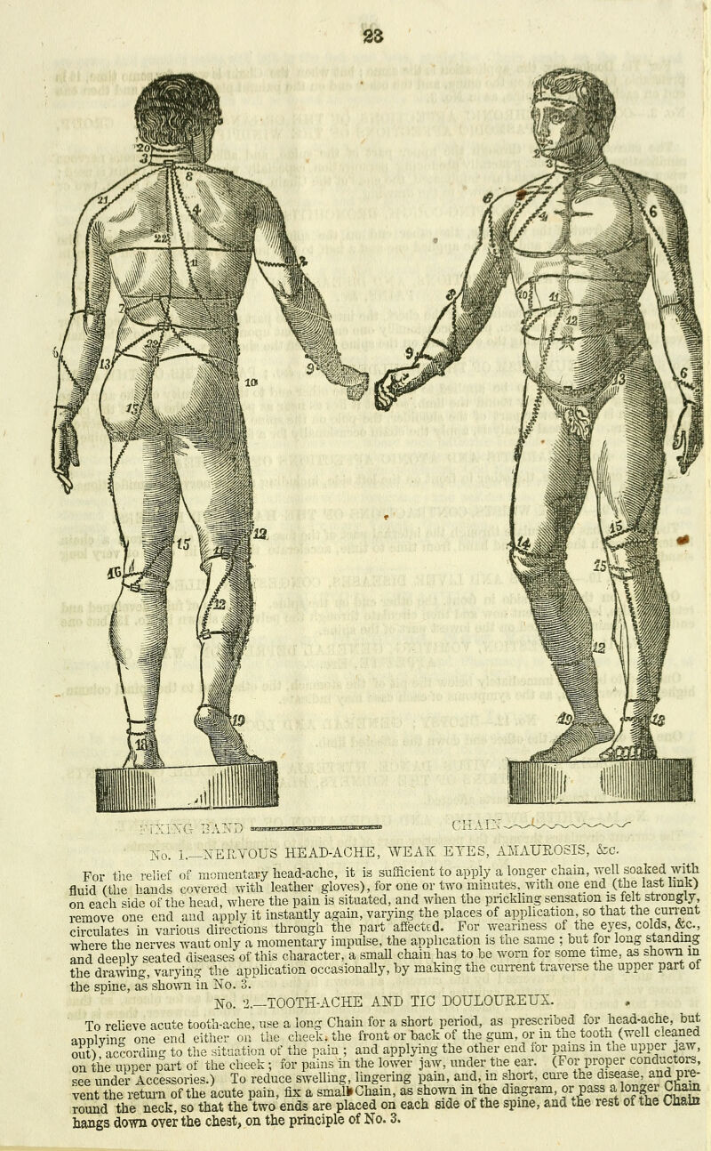 No. I.— NERVOUS HEAD-ACHE, WEAK EYES, AMAUROSIS, &0. For the relief of momentary head-ache, it is sufficient to apply a longer chain, vfell soaked with fluid (the hands covered with leather gloves), for one or two minutes, with one end (the last link) on each side of the head, where the pain is situated, and when the prickling sensation is felt strongly remove one end and apply it instantly again, varying the places of application so that the current circulates in various directions through the part affected. For weariness of the eyes, colds &c., where the nerves wautonly a momentary impulse, the application is tne same ; buu for long standing and deeply seated diseases of this character, a small chain has to be worn for some time, as shown m the drawing varying the application occasionally, by making tne current traverse the upper part ol the spine, as shown in No. 3. No. -TOOTH-ACHE AND TIC DOULOUREUX. To relieve acute tooth-ache, use a long Chain for a short period, as prescribed for head-ache, but mlvin- one end either on the cheek, the front or back of the gum, or in tne tooth (well cleaned ,tA 0,.pnrriiT,<r to thfi situation of the nain : and applying the other end for pains m tne upper jaw, applyi out), according to the situation of the pain ; and applying the otner end for pains m tne upper jaw, on the upper part of the cheek; for pains in the lower jaw, under tne ear. (For proper conductors, see under Accessories.) To reduce swelling, lingering pain, and, in short, erne the disease, and pre- vent the return of the acute pain, fix a smalkChain, as shown in the diagram or pass a longer Cham round the neck, so that the two ends are placed on each side of the spine, and the rest of the Chain hangs down over the chest, on the principle of No. 3.