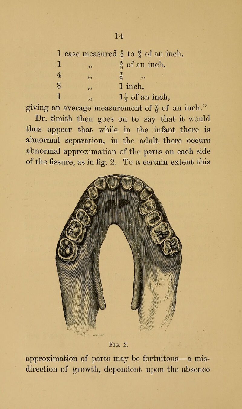 1 case measured f to f of an inch, 1 ,5 f of an incli, 4 ^ 3 5, 1 inch, 1 ,, 1-g- of an inch, giving an average measurement off of an incli. Dr. Smith then goes on to say that it would thus appear that while in the infant there is abnormal separation, in the adult there occurs abnormal approximation of the parts on each side of the fissure, as in fig. 2. To a certain extent this Fig. 2. approximation of parts may be fortuitous—a mis- direction of growth, dependent upon the absence