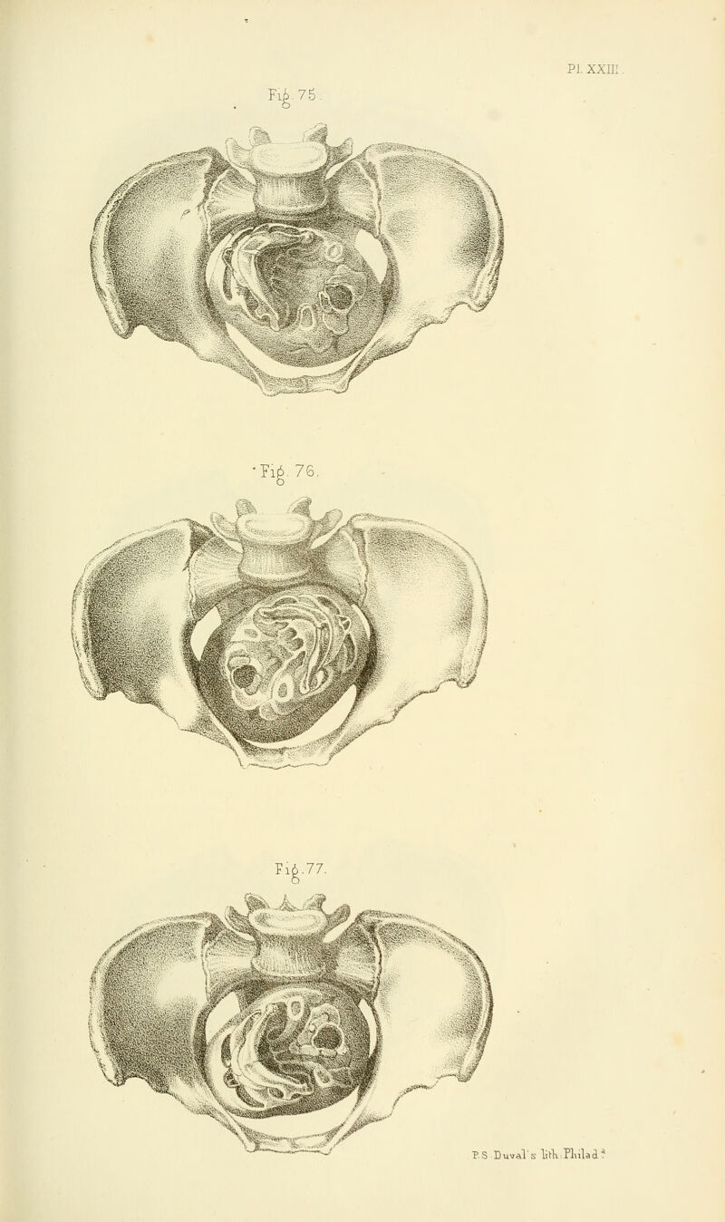 Fii.76 VI. XXIII I I 1 !•**■* - w °r- Pig. 76. SS9*3 ?fti'%s,^M \ SB I'i « BS Duval's lifK-.Pluladf
