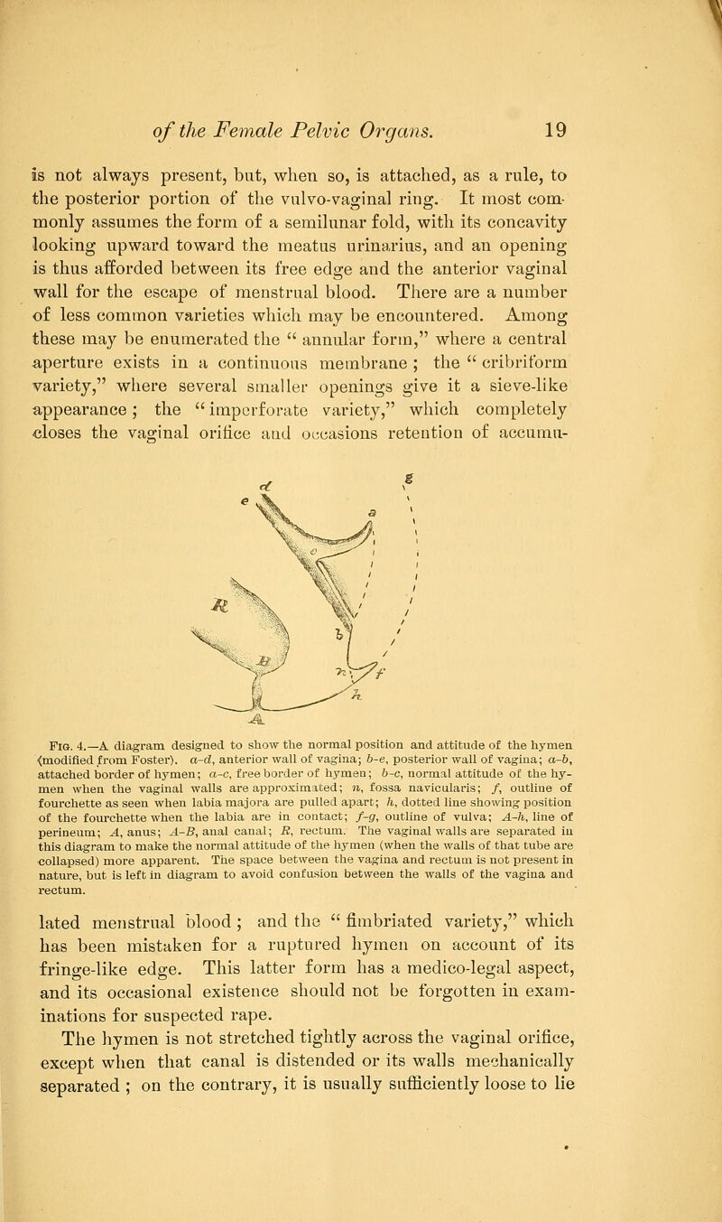 is not always present, but, when so, is attached, as a rule, to the posterior portion of the vulvo-vaginal ring. It most com- monly assumes the form of a semilunar fold, with its concavity looking upward toward the meatus urinarius, and an opening is thus afforded between its free edge and the anterior vaginal wall for the escape of menstrual blood. There are a number of less common varieties which may be encountered. Among these may be enumerated the  annular form, where a central aperture exists in a continuous membrane ; the  cribriform variety, where several smaller openings give it a sieve-like appearance; the  imperforate variety, which completely closes the vaginal orifice and occasions retention of accumu- Fig. 4.—A diagram designed to show the normal position and attitude of the hymen ^modified from Foster), a-d, anterior wall of vagina; b-e, posterior wall of vagina; a-b, attached border of hymen; a-c, free border of hymen; b-c, normal attitude of the hy- men when the vaginal walls are approximated; n, fossa navicularis; /, outline of fourchette as seen when labia majora are pulled apart; h, dotted line showing position of the fourchette when the labia are in contact; f-g, outline of vulva; A-h, line of perineum; A, anus; A-B, anal canal; B, rectum. The vaginal walls are separated in this diagram to make the normal attitude of the hymen (when the walls of that tube are collapsed) more apparent. The space between the vagina and rectum is not present in nature, but is left in diagram to avoid confusion between the walls of the vagina and rectum. lated menstrual blood ; and the  fimbriated variety, which has been mistaken for a ruptured hymen on account of its fringe-like edge. This latter form has a medico-legal aspect, and its occasional existence should not be forgotten in exam- inations for suspected rape. The hymen is not stretched tightly across the vaginal orifice, except when that canal is distended or its walls mechanically separated ; on the contrary, it is usually sufficiently loose to lie