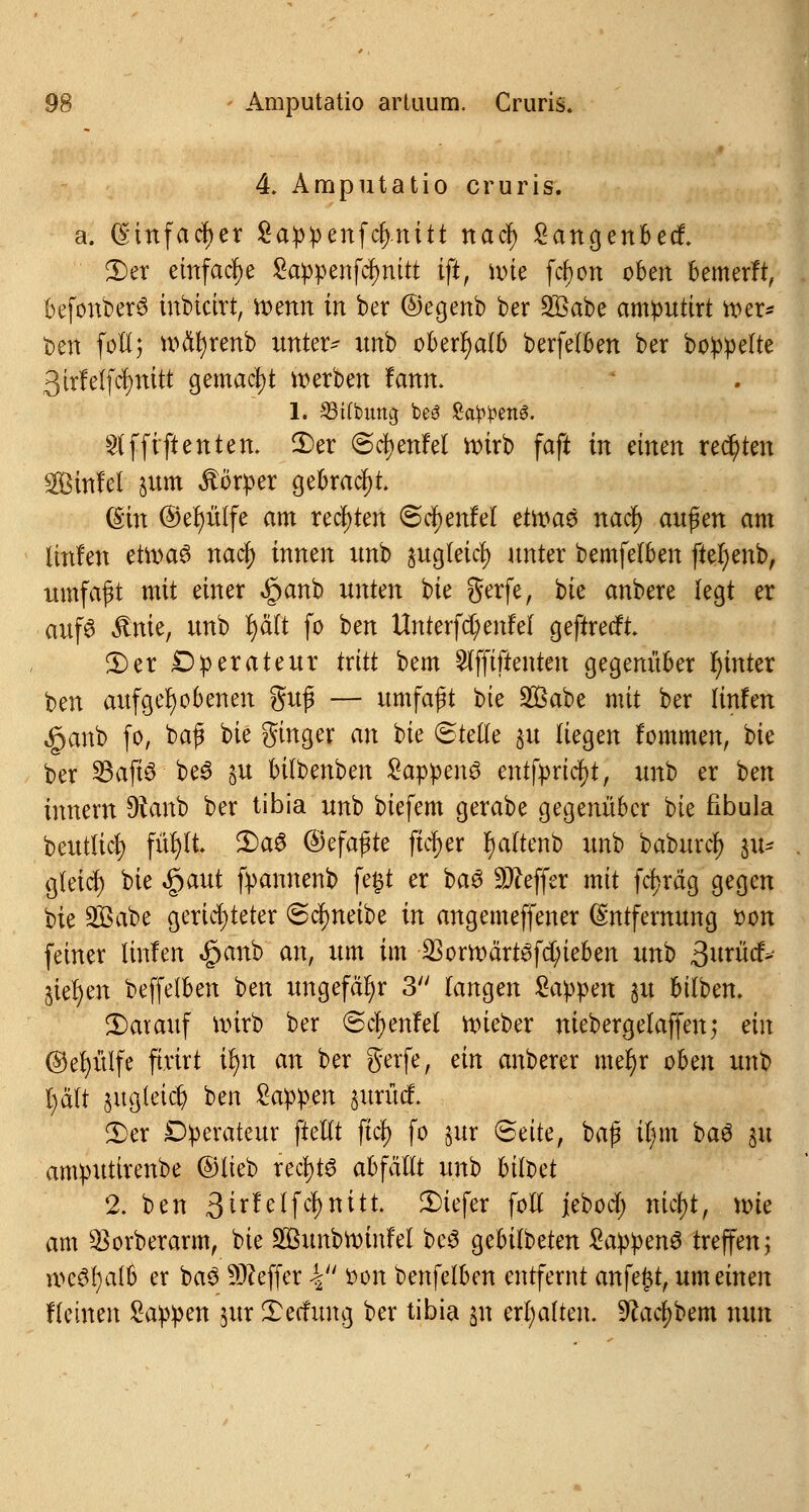 4. Amputatio cruris. a. Einfacher £a:p:penfcl).nitt nad) £angenbed 2)er einfache Sappenfctymtt ift, roie fcfjon oben bemerft, befonberS inbieirt, roenn in ber ©egenb ber 2Babe amputirt roer* t)en foll; wäfyrenb untere itnb oberhalb berfelben ber bereite 3irfelfc^ttitt gemacht werben fann. 1. S3tfbung bes Samens. 2lffiftenten, 3)er ©cfyenfel roirb faft in einen regten Sinfet §um Körper gebraut (Sin @er)ülfe am rechten ©d^enfel etroas naef) außen am linfen etroaö naef) innen imb jug(eicr) unter bemfelben ftefyenb, umfaßt mit einer §anb unkn bie gerfe, Uc anbere legt er auf6 Sink, imb fyaTt fo ben Unterfd)enfef geftreeft 3) er Operateur tritt bem £lfftftenten gegenüber hinter ben aufgehobenen guß — umfaßt ^)k $ß<fi>t mit ber linfen §anb fo, baß bie ginger an bie (Stelle $u liegen fommen, bie ber 33aft$be$ §u bilbenben Sappenö entpprtd)t, unb er ben innem föanb ber tibia unb btefem gerabe gegenüber bie fibula beutlicl) füt)It £>a6 ©efaßte fieser fjaltenb unb baburefj $ü* gteid) bie «gaut fpannenb fegt er i>a$ Keffer mit fcfjräg gegen bte 233 ab e gerichteter ©cfyneibe in angemeffener Entfernung *>on feiner linfen £anb an, um im $orroärt£fd;ieben unh ßmM* Sieben beffelben ben ungefähr 3 langen Zappm §u hilhcn. darauf voirb ber «Scfyenfel roieber niebergelaffenj ein ©efyülfe ftrirt ü)n an ber gerfe, ein anberer mefyr oben unb r)äft §ug(et$ ben Zaypm §urüi£ £>er Operateur fteltt fiel) fo jur (Bette, baß u)m ba3 31t amputirenbe ©lieb recfyts abfällt itnb bilbet 2. ben 3irfelfcl>nitt tiefer foll jeboäf) nicl)t, tote am SBorberarm, bie SBunbttrinfel beS gebilbeten Wappens treffen; n>c3()a(b er ba3 Keffer 4 oon benfetben entfernt anfei$t, um einen fleinen £appen &ur Xecfung ber tibia 31t erhalten. -IRac^bem nun