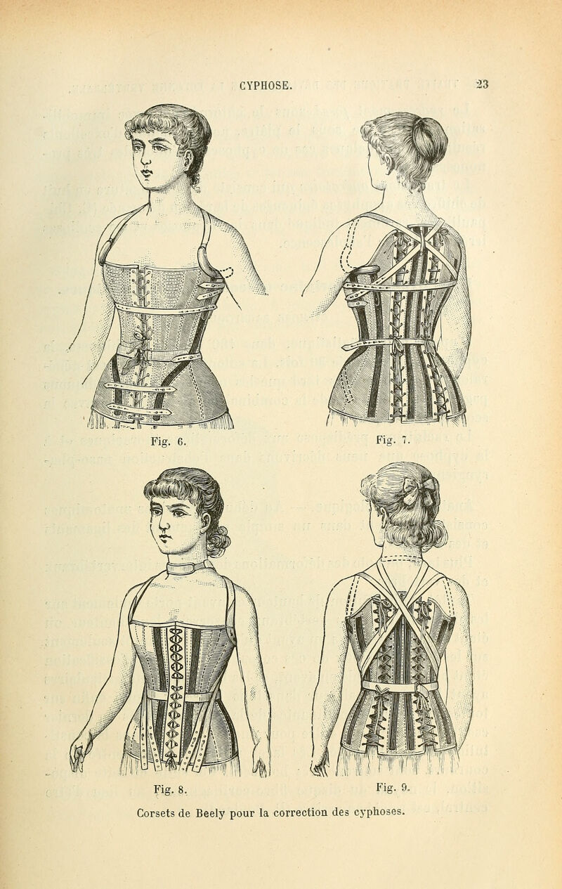 Fig. 6. Fis. 7. Fig. 8. Fig. 9. Corsets de Beely pour la correction des cyphoses.