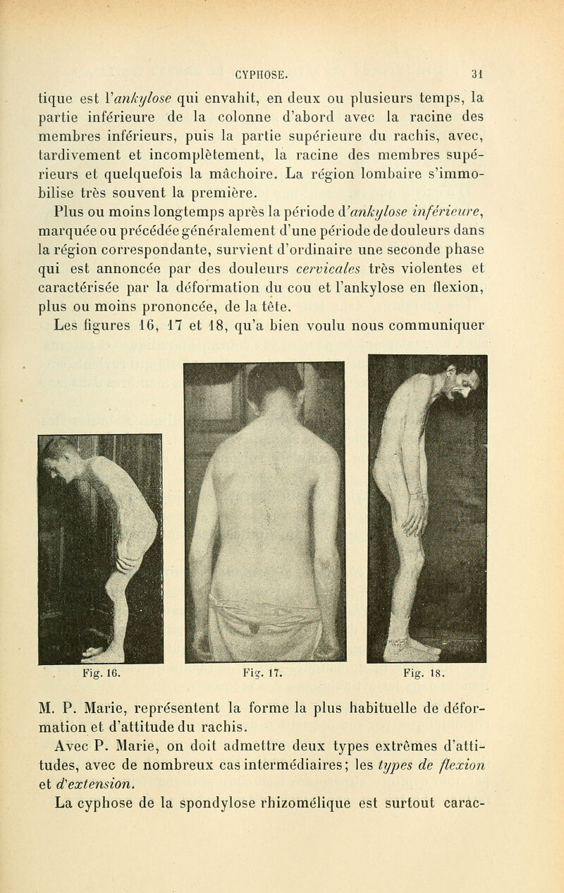 tique est Yankylose qui envahit, en deux ou plusieurs temps, la partie inférieure de la colonne d'abord avec la racine des membres inférieurs, puis la partie supérieure du rachis, avec, tardivement et incomplètement, la racine des membres supé- rieurs et quelquefois la mâchoire. La région lombaire s'immo- bilise très souvent la première. Plus ou moins longtemps après la période <¥ankylose inférieure, marquée ou précédée généralement d'une période de douleurs dans la région correspondante, survient d'ordinaire une seconde phase qui est annoncée par des douleurs cervicales très violentes et caractérisée par la déformation du cou et l'ankylose en flexion, plus ou moins prononcée, de la tête. Les figures 16, 17 et 18, qu'a bien voulu nous communiquer Fig. 16. Fier. 17. Fie. 18. M. P. Marie, représentent la forme la plus habituelle de défor- mation et d'attitude du rachis. Avec P. Marie, on doit admettre deux types extrêmes d'atti- tudes, avec de nombreux cas intermédiaires ; les types de flexion et d'extension. La cyphose de la spondylose rhizomélique est surtout carac-