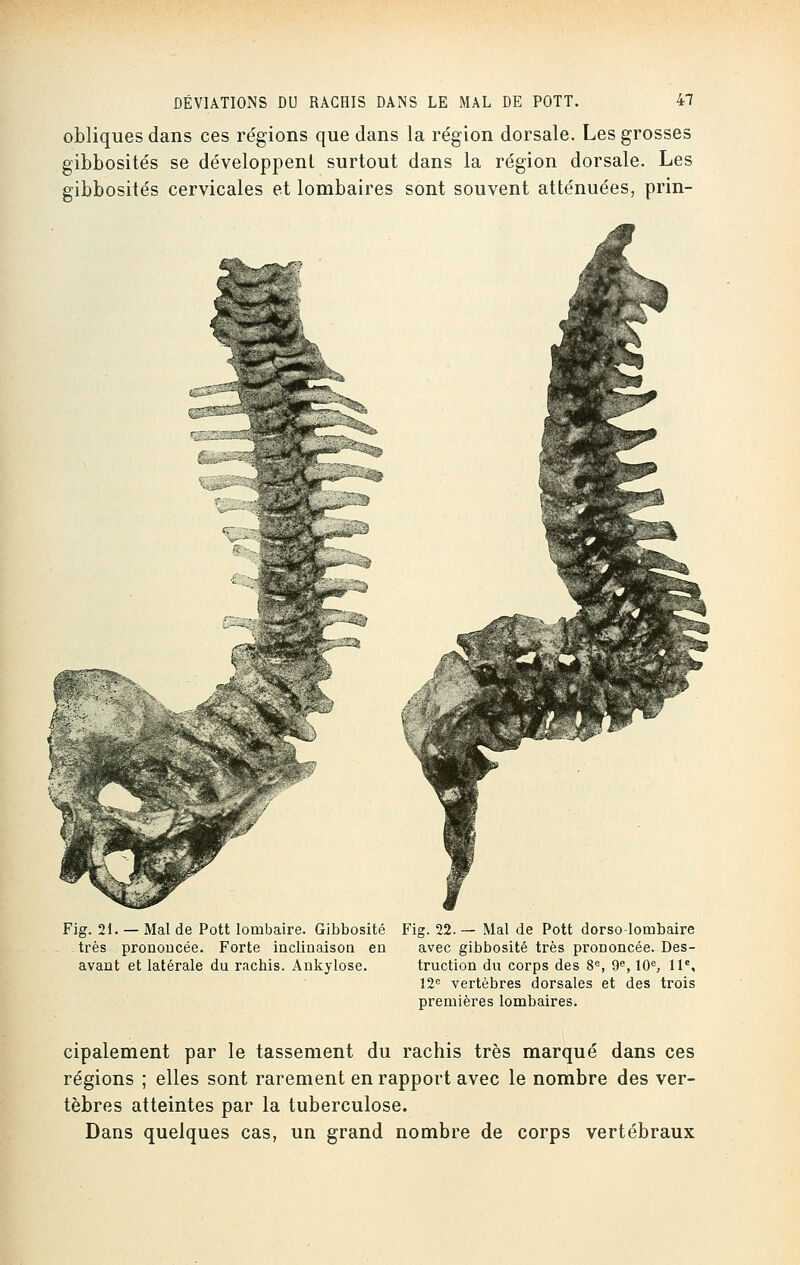 obliques dans ces régions que dans la région dorsale. Les grosses gibbosités se développent surtout dans la région dorsale. Les gibbosités cervicales et lombaires sont souvent atténuées, prin- Fig. 21. — Mal de Pott lombaire. Gibbosité très prononcée. Forte inclinaison en avant et latérale du rachis. Ankylose. Fig. 22. — Mal de Pott dorso-lonibaire avec gibbosité très prononcée. Des- truction du corps des 8e, 9e, 10e, 11e, 12e vertèbres dorsales et des trois premières lombaires. cipalement par le tassement du rachis très marqué dans ces régions ; elles sont rarement en rapport avec le nombre des ver- tèbres atteintes par la tuberculose. Dans quelques cas, un grand nombre de corps vertébraux