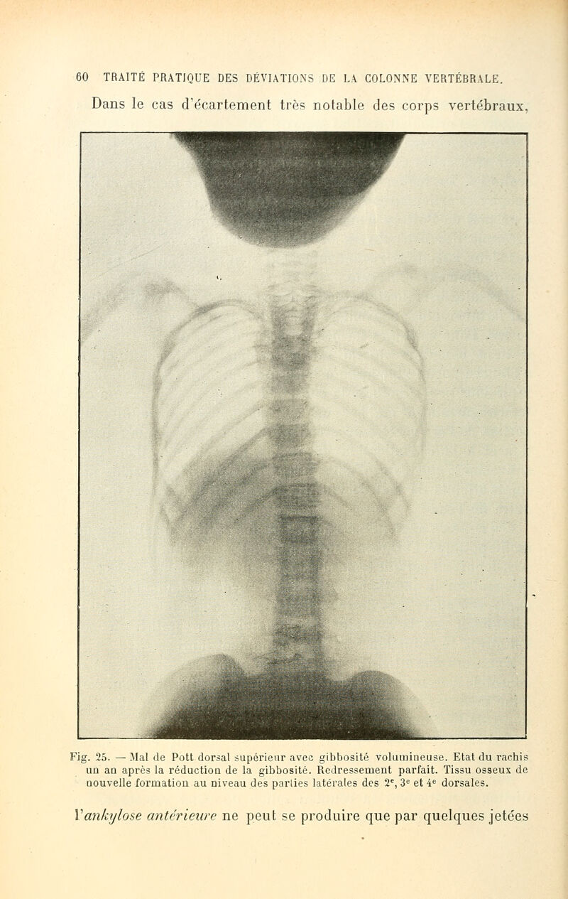 Dans le cas cTécartement très notable des corps vertébraux. Fig. 25. — Mal de Pott dorsal supérieur avec gibbosité volumineuse. Etat du rachis un an après la réduction de la gibbosité. Redressement parfait. Tissu osseux de nouvelle formation au niveau des parties latérales des 2e, 3e et 4e dorsales. Yankylose antérieure ne peut se produire que par quelques jetées