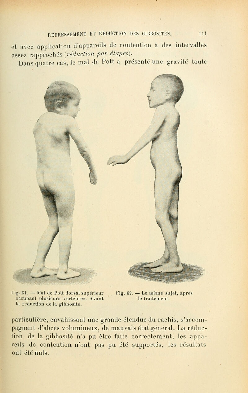 et avec application d'appareils de contention à des intervalles assez rapprochés (réduction par étapes). Dans quatre cas, le mal de Pott a présenté une gravité toute Fig. 61. — Mal de Pott dorsal supérieur occupant plusieurs vertèbres. Avant la réduction de la gibbosité. Fig. 62. — Le même sujet, après le traitement. particulière, envahissant une grande étendue du rachis, s'accom- pagnant d'abcès volumineux, de mauvais état général. La réduc- tion de la gibbosité n'a pu être faite correctement, les appa- reils de contention n'ont pas pu été supportés, les résultats ont été nuls.