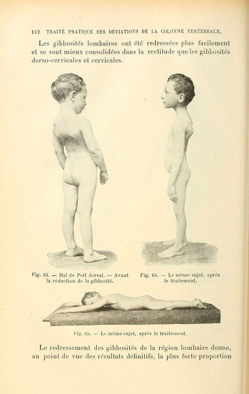 Les gibbosités lombaires ont été redressées plus facilement et se sont mieux consolidées dans la rectitude que les gibbosités dorso-cervicales et cervicales. k ■■ ■ Fig. 63. — Mal de Pott dorsal. — Avant Fig. 64. — Le même sujet, après la réduction de la gibbosité. le traitement. <PT^ Hg. 65. — Le même sujet, après le traitement. Le redressement des gibbosités de la région lombaire donne, au point de vue des résultats définitifs, la plus forte proportion