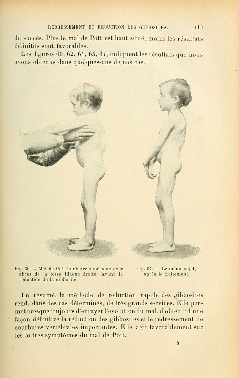 de succès. Plus le mal de Pott est haut situé, moins les résultats définitifs sont favorables. Les figures 60, 62, 64, 6o, 67, indiquent les résultats que nous avons obtenus dans quelques-uns de nos cas. Fig. 66 — Mal de Pott lombaire supérieur avec abcès de la fosse iliaque droite. Avant la réduction de la gibbosité. Fig. 67. — Le même sujet, après le traitement. En résumé, la méthode de réduction rapide des gibbosités rend, dans des cas déterminés, de très grands services. Elle per- met presque toujours d'enrayer l'évolution du mal, d'obtenir d'une façon définitive la réduction des gibbosités et le redressement de courbures vertébrales importantes. Elle agit favorablement sur les autres symptômes du mal de Pott.