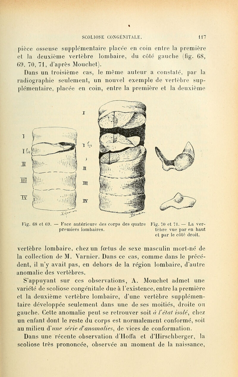 pièce osseuse supplémentaire place'e en coin entre la première et la deuxième vertèbre lombaire, du côté gauche (fig. 68, 69. 70, 71, d'après Mouchet). Dans un troisième cas, le même auteur a constaté, par la radiographie seulement, un nouvel exemple de vertèbre sup- plémentaire, placée en coin, entre la première et la deuxième Fig. 68 et 69. — Face antérieure des corps des quatre Fig. 70 et 7t. — La ver- premiers lombaires. tèhre vue par en haut et par le côté droit. vertèbre lombaire, chez un fœtus de sexe masculin mort-né de la collection de M. Varnier. Dans ce cas, comme clans le précé- dent, il n'y avait pas, en dehors de la région lombaire, d'autre anomalie des vertèbres. S'appuyant sur ces observations, A. Mouchet admet une variété de scoliose congénitale due à l'existence, entre la première et la deuxième vertèbre lombaire, d'une vertèbre supplémen- taire développée seulement dans une de ses moitiés, droite ou gauche. Cette anomalie peut se retrouver soit à l'état isolé, chez un enfant dont le reste du corps est normalement conformé, soit au milieu d'une série d'anomalies, de vices de conformation. Dans une récente observation d'Hoffa et d'Hirschberger, la scoliose très prononcée, observée au moment de la naissance,