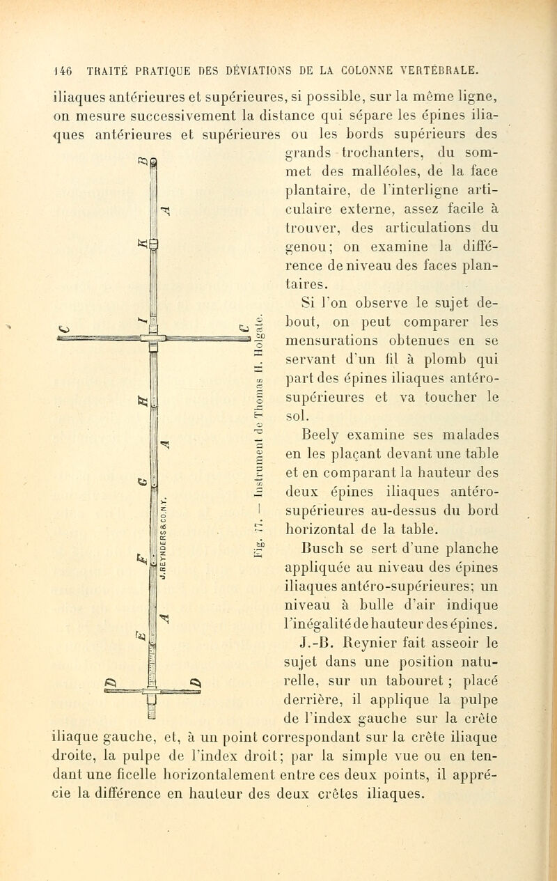 ^fl *< M ^i ci iliaques antérieures et supérieures, si possible, sur la même ligne, on mesure successivement la distance qui sépare les épines ilia- ques antérieures et supérieures ou les bords supérieurs des grands trochanters, du som- met des malléoles, de la face plantaire, de l'interligne arti- culaire externe, assez facile à trouver, des articulations du genou ; on examine la diffé- rence de niveau des faces plan- taires. Si Ton observe le sujet de- bout, on peut comparer les mensurations obtenues en se servant d'un fil à plomb qui part des épines iliaques antéro- supérieures et va toucher le sol. Beely examine ses malades en les plaçant devant une table et en comparant la hauteur des deux épines iliaques antéro- supérieures au-dessus du bord horizontal de la table. Busch se sert d'une planche appliquée au niveau des épines iliaques antéro-supérieures; un niveau à bulle d'air indique Finégalité de hauteur des épines. J.-B. Reynier fait asseoir le sujet dans une position natu- relle, sur un tabouret ; placé derrière, il applique la pulpe de l'index gauche sur la crête iliaque gauche, et, à un point correspondant sur la crête iliaque droite, la pulpe de l'index droit ; par la simple vue ou en ten- dant une ficelle horizontalement entre ces deux points, il appré- cie la différence en hauteur des deux crêtes iliaques. S iu 1 LU z >■ - w os •à r*4 S f r ^ ^