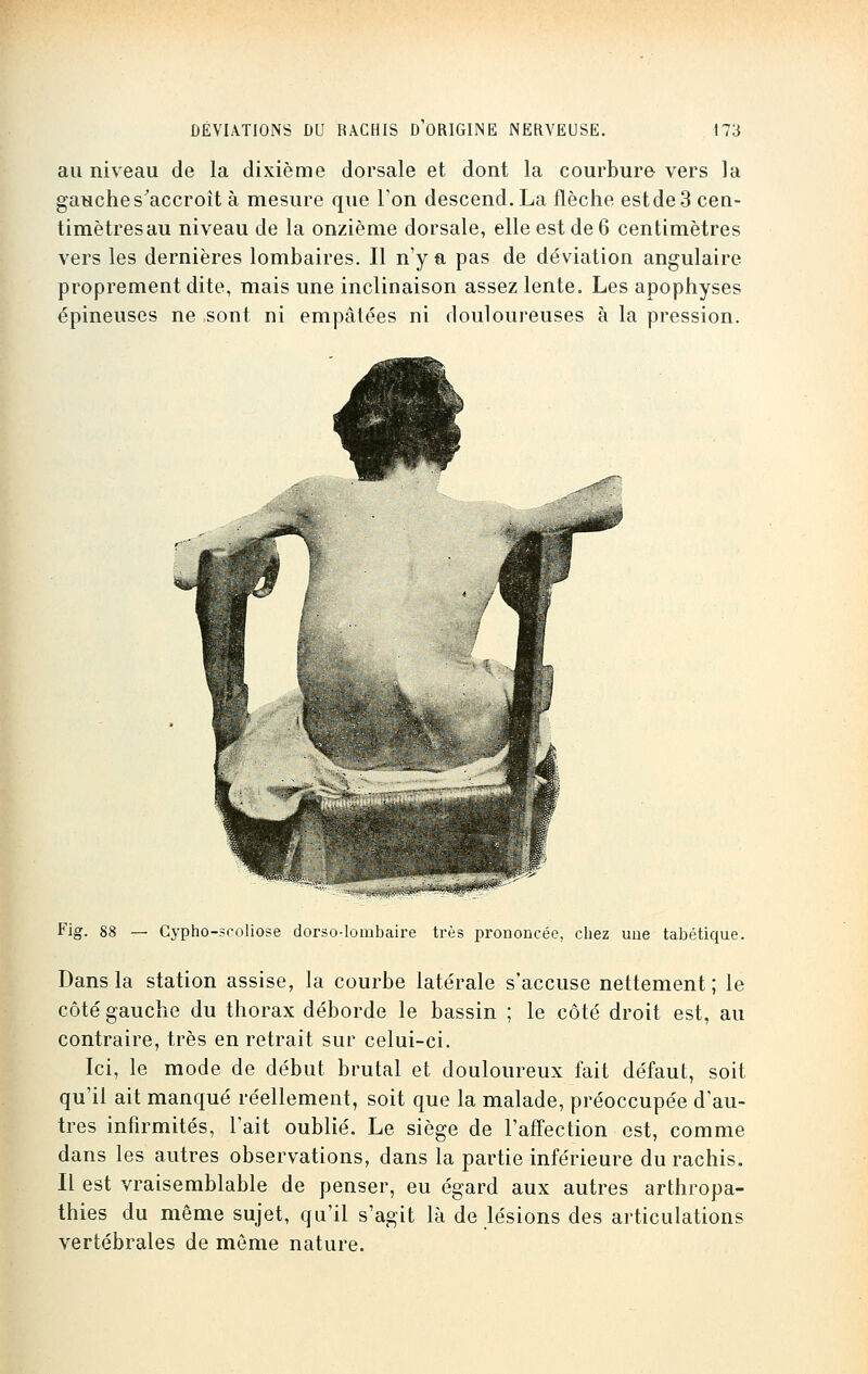 au niveau de la dixième dorsale et dont la courbure vers la gauche s'accroît à mesure que Ton descend. La flèche est de 3 cen- timètres au niveau de la onzième dorsale, elle est de 6 centimètres vers les dernières lombaires. Il n'y a pas de déviation angulaire proprement dite, mais une inclinaison assez lente. Les apophyses épineuses ne ,sont ni empâtées ni douloureuses à la pression. Fig. 88 — Cypho-scoliose dorso-lombaire très prononcée, chez une tabétique. Dans la station assise, la courbe latérale s'accuse nettement; le côté gauche du thorax déborde le bassin ; le côté droit est, au contraire, très en retrait sur celui-ci. Ici, le mode de début brutal et douloureux fait défaut, soit qu'il ait manqué réellement, soit que la malade, préoccupée d'au- tres infirmités, l'ait oublié. Le siège de l'affection est, comme dans les autres observations, dans la partie inférieure du rachis. Il est vraisemblable de penser, eu égard aux autres arthropa- thies du même sujet, qu'il s'agit là de lésions des articulations vertébrales de môme nature.