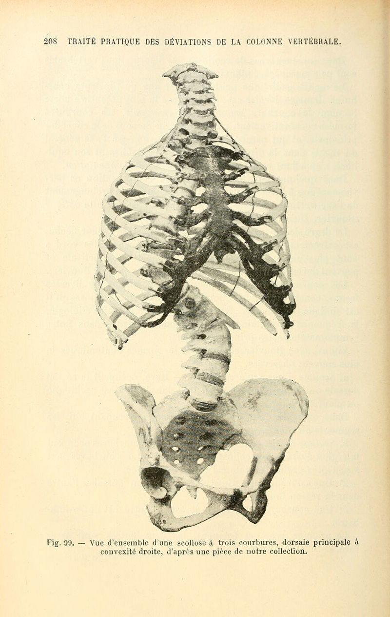 Fig. 99. — Vue d'ensemble d'une scoliose à trois courbures, dorsale principale à convexité droite, d'après une pièce de notre collection.