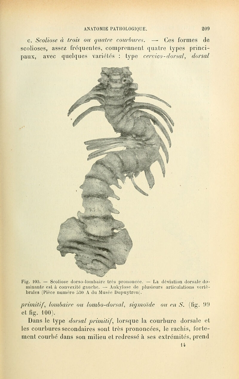 c. Scoliose à trois ou quatre courbures. — Ces formes de scolioses, assez fréquentes, comprennent quatre types princi- paux, avec quelques variétés : type cervico-dorsal, dorsal Fig. 100. — Scoliose dorso-lombaire très prononcée. — La déviation dorsale do- minante esL à convexité gauche. — Ankylose de plusieurs articulations verté- brales (Pièce numéro 530 A du Musée Dupuytren). primitif, lombaire ou lombo-dorsal, sigmoïde ou en S. (fig. 99 et fig. 100). Dans le type dorsal primitif, lorsque la courbure dorsale et les courbures secondaires sont très prononcées, le rachis, forte- ment courbé dans son milieu et redressé à ses extrémités, prend 14