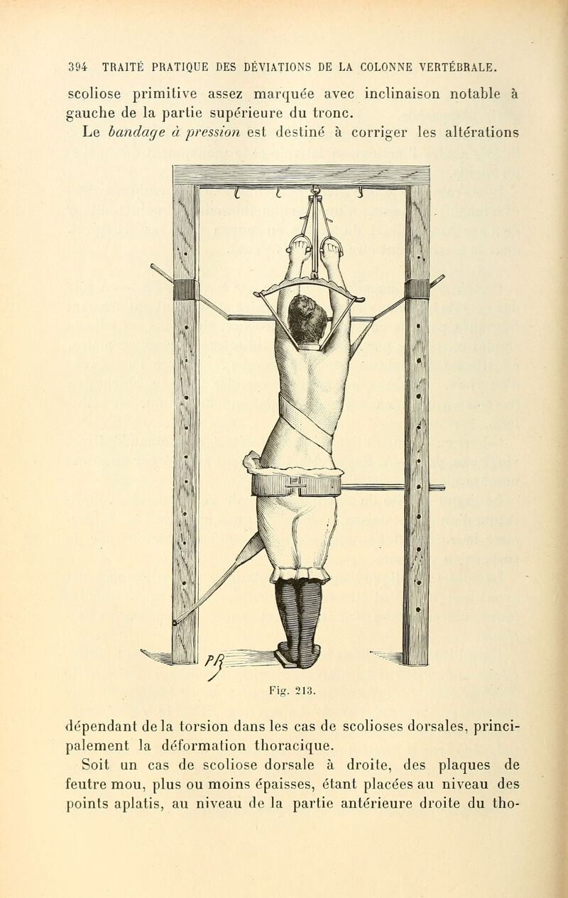 scoliose primitive assez marquée avec inclinaison notable à gauche de la partie supérieure du tronc. Le bandage à pression est destiné à corriger les altérations Fig. 213. dépendant delà torsion dans les cas de scolioses dorsales, princi- palement la déformation thoracique. Soit an cas de scoliose dorsale à droite, des plaques de feutre mou, plus ou moins épaisses, étant placées au niveau des points aplatis, au niveau de la partie antérieure droite du tho-