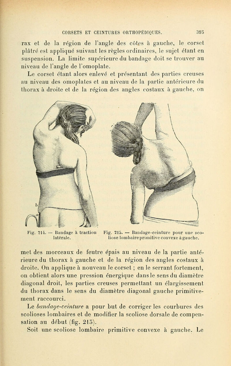 rax et de la région de l'angle des côtes à gauche, le corset plâtré est appliqué suivant les règles ordinaires, le sujet étant en suspension. La limite supérieure du bandage doit se trouver au niveau de l'angle de l'omoplate. Le corset étant alors enlevé et présentant des parties creuses au niveau des omoplates et au niveau de la partie antérieure du thorax à droite et de la région des angles costaux à gauche, on Fig. 214. — Bandage à traction latérale. Fig. 215. — Bandage-ceinture pour une sco- liose lonibaireprimitive couvexe àgauche. met des morceaux de feutre épais au niveau de la partie anté- rieure du thorax à gauche et de la région des angles costaux à droite. On applique à nouveau le corset ; en le serrant fortement, on obtient alors une pression énergique dans le sens du diamètre diagonal droit, les parties creuses permettant un élargissement du thorax dans le sens du diamètre diagonal gauche primitive- ment raccourci. Le bandage-ceinture a pour but de corriger les courbures des scolioses lombaires et de modifier la scoliose dorsale de compen- sation au début (fig. 215). Soit une scoliose lombaire primitive convexe à gauche. Le