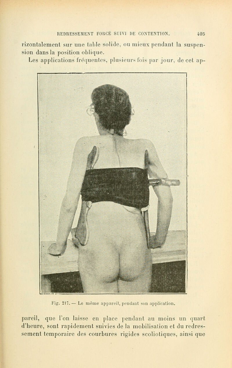 rizontalement sur une table solide, ou mieux pendant la suspen- sion dans la position oblique. Les applications fréquentes, plusieurs fois par jour, de cet ap- Fig. 217.— Le même appareil, pendant son application. pareil, que l'on laisse en place pendant au moins un quart d'heure, sont rapidement suivies de la mobilisation et du redres- sement temporaire des courbures rigides scoliotiques, ainsi que