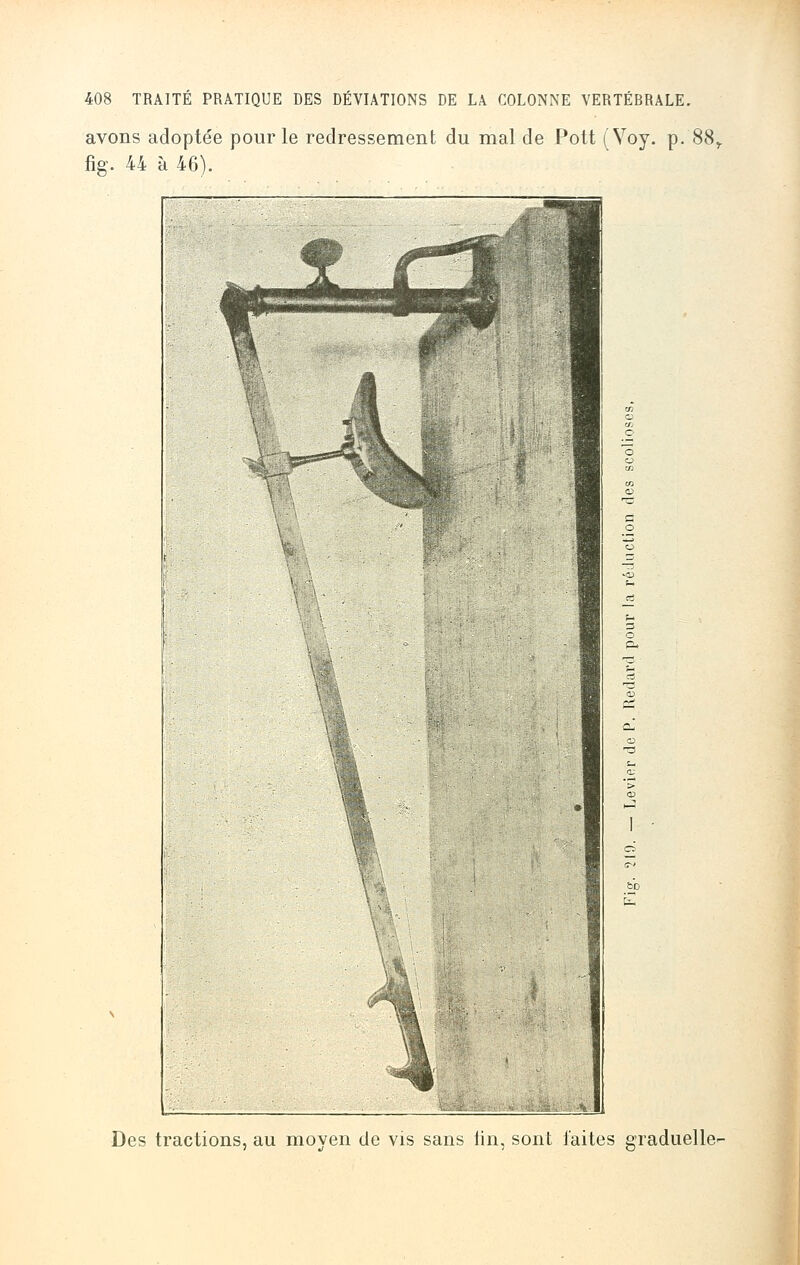 avons adoptée pour le redressement du mal de Pott (Voy. p. 88r fig. 44 à 46). Des tractions, au moyen de vis sans lin, sont laites graduelle-