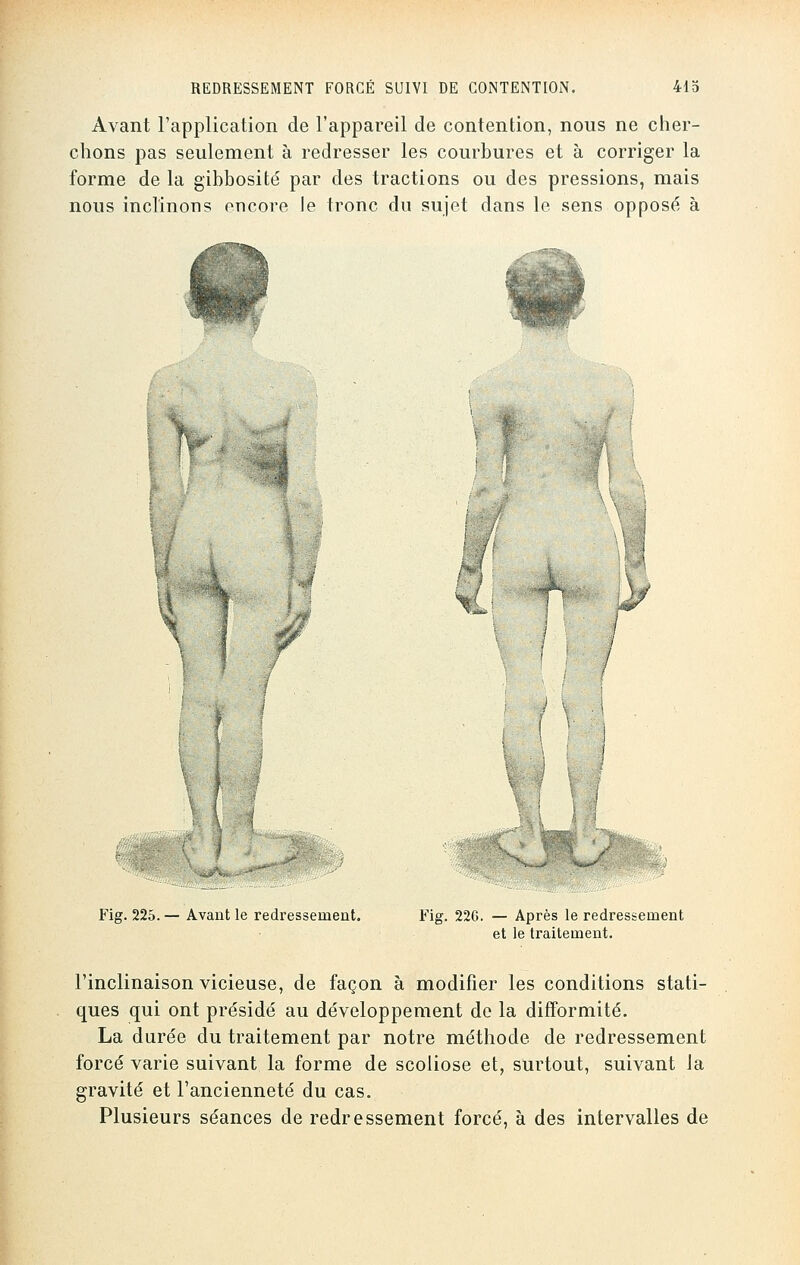 Avant l'application de l'appareil de contention, nous ne cher- chons pas seulement à redresser les courbures et à corriger la forme de la gibbosité par des tractions ou des pressions, mais nous inclinons encore le tronc du sujet dans le sens opposé à / P F / / Fig. 225. — Avant le redressement. F'ig. 22G. — Après le redressement et le traitement. l'inclinaison vicieuse, de façon à modifier les conditions stati- ques qui ont présidé au développement de la difformité. La durée du traitement par notre méthode de redressement forcé varie suivant la forme de scoliose et, surtout, suivant la gravité et l'ancienneté du cas. Plusieurs séances de redressement forcé, à des intervalles de