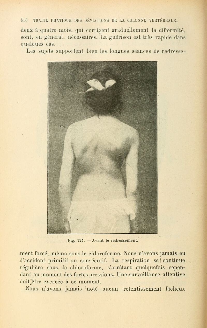 deux à quatre mois, qui corrigent graduellement la difformité, sont, en général, nécessaires. La guérison est très rapide dans quelques cas. Les sujets supportent bien les longues séances de redresse- Fi#. 227. —Avant le redressement. ment forcé, même sous le chloroforme. Nous n'avons jamais eu d'accident primitif ou consécutif. La respiration se i continue régulière sous le chloroforme, s'arrêtant quelquefois cepen- dant au moment des fortes pressions. Une surveillance attentive doit^être exercée à ce moment. Nous n'avons jamais noté aucun retentissement fâcheux