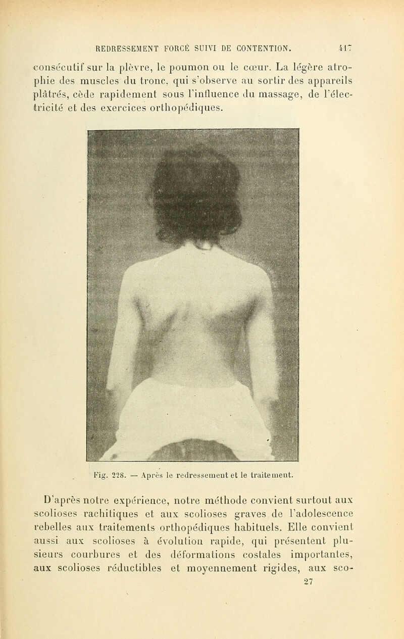 consécutif sur la plèvre, le poumon ou le cœur. La légère atro- phie des muscles du tronc, qui s'observe au sortir des appareils plâtrés, cède rapidement sous l'influence du massage, de l'élec- tricité et des exercices orthopédiques. Fig. 228. — Après le redressement et le traitement. D'après notre expérience, notre méthode convient surtout aux scolioses rachitiques et aux scolioses graves de l'adolescence rebelles aux traitements orthopédiques habituels. Elle convient aussi aux scolioses à évolution rapide, qui présentent plu- sieurs courbures et des déformations costales importantes, aux scolioses réductibles et moyennement rigides, aux sco- 27