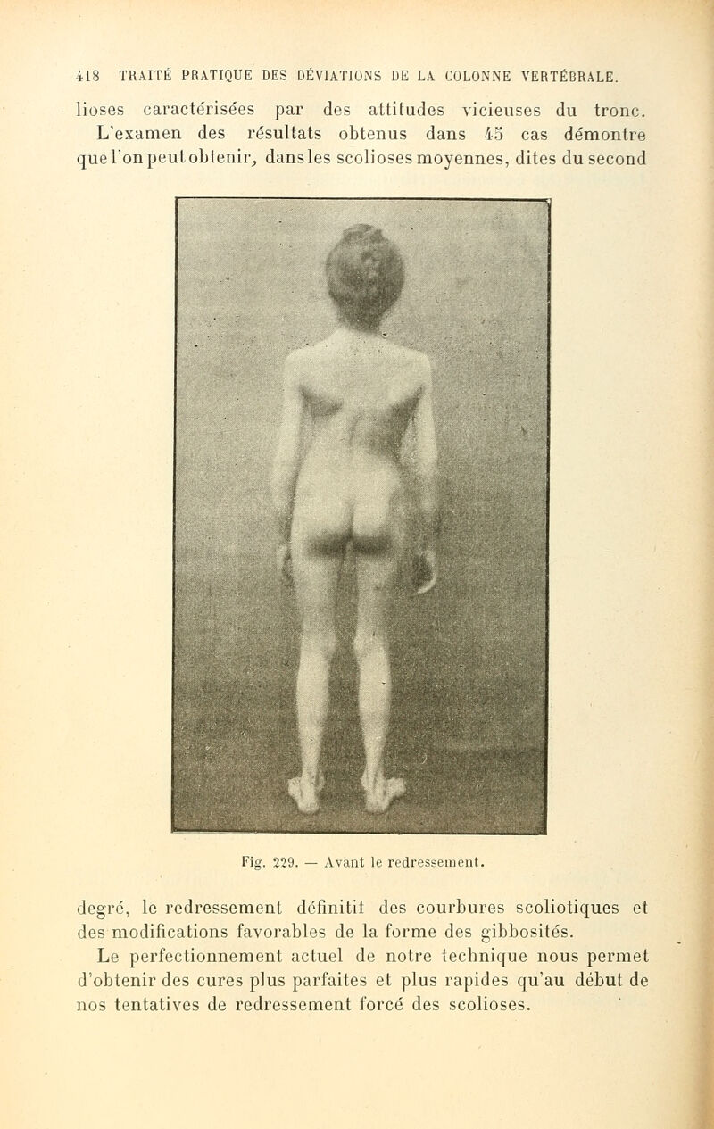 lioses caractérisées par des attitudes vicieuses du tronc. L'examen des résultats obtenus dans 45 cas démontre que l'on peutobtenir, dansles scolioses moyennes, dites du second Fig. 229. — Avant le redressement. degré, le redressement définitit des courbures scoliotiques et des modifications favorables de la forme des gibbosités. Le perfectionnement actuel de notre technique nous permet d'obtenir des cures plus parfaites et plus rapides qu'au début de nos tentatives de redressement forcé des scolioses.