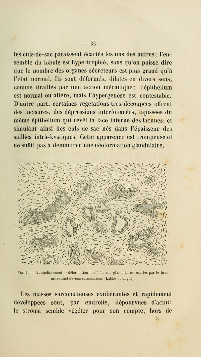 les culs-de-sac paraissent écartés les uns des autres; l'en- semble du lobule est hypertrophié, sans qu'on puisse dire que le nombre des organes sécréteurs est plus grand qu'à l'état normal. Ils sont déformés, dilatés en divers sens, comme tiraillés par une action mécanique; l'épithélium est normal ou altéré, mais l'hypergenèse esi contestable. D'autre part, certaines végétations très-découpées offrent des incisures, des dépressions interfoliacées, tapissées du même épithélium qui revêt la face interne des lacunes, et simulant ainsi des culs-de-sac nés dans l'épaisseur des saillies intrà-kystiques. Cette apparence est trompeuse et ne suffit pas à démontrer une néoformatiou glandulaire. Fig. 4. — Agrandissement et déformation des éléments glandulaires, écartés par le tissu interstitiel devenu sarcomateux (Labbé et Coyne). Les masses sarcomateuses exubérantes et rapidement développées sont, par endroits, dépourvues d'acini; le stroma semble végéter pour son compte, hors de