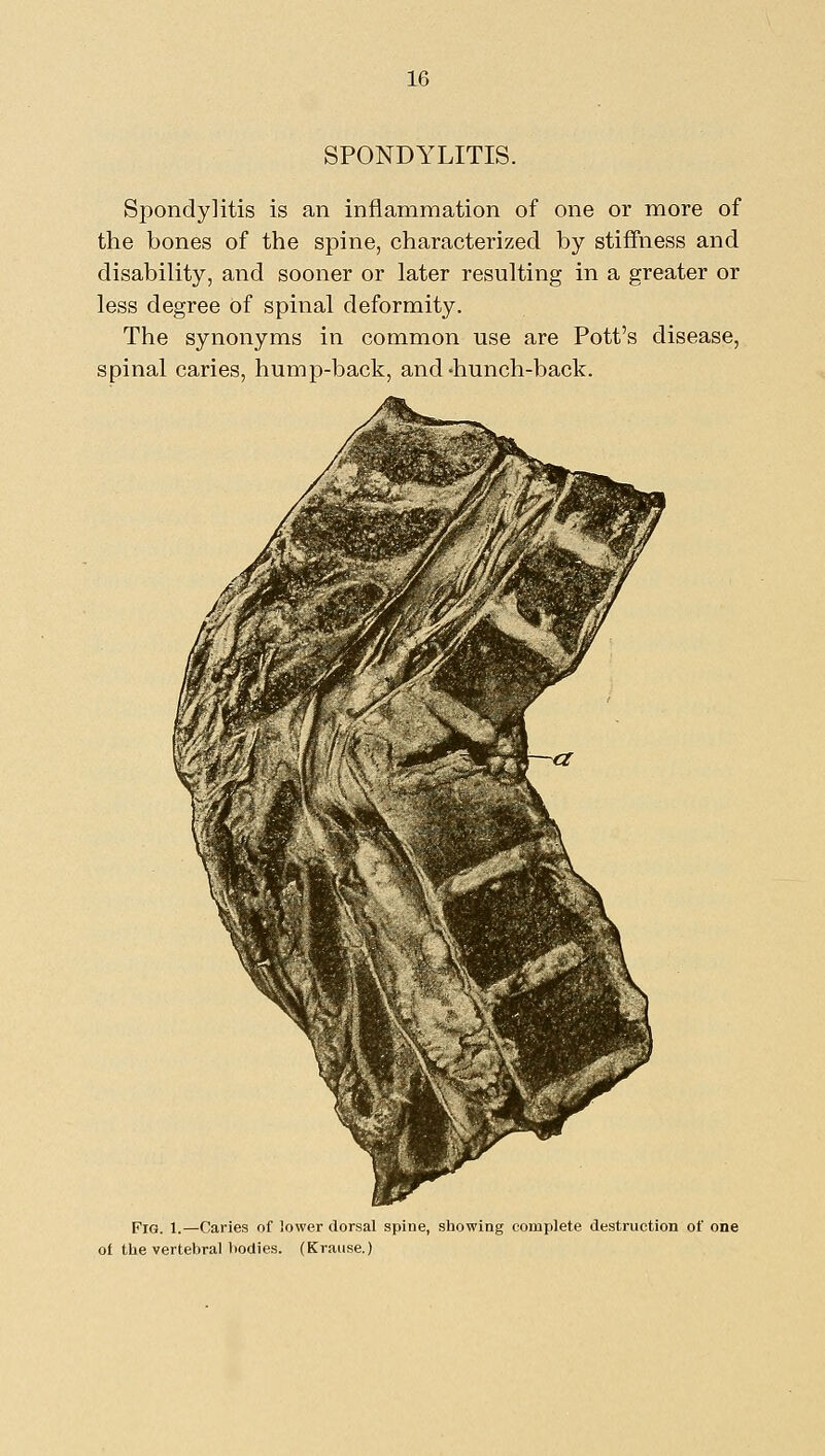 SPONDYLITIS. Spondylitis is an inflammation of one or more of the bones of the spine, characterized by stiffness and disability, and sooner or later resulting in a greater or less degree of spinal deformity. The synonyms in common use are Pott's disease, spinal caries, hump-back, and 'hunch-back. Fig. 1.—Caries of lower dorsal spine, showing complete destruction of one of the vertebral bodies. (Kraiise.)