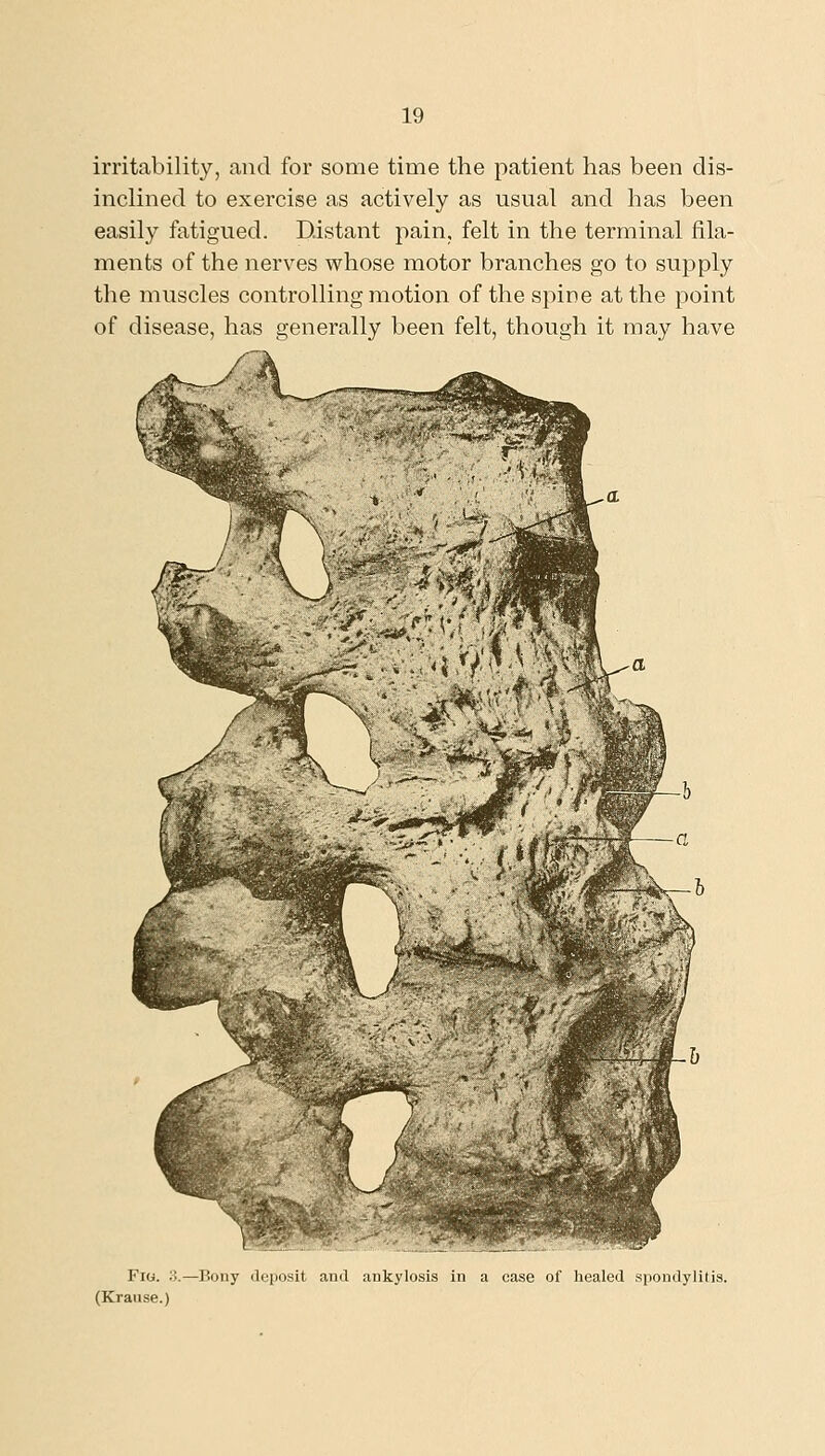 irritability, and for some time the patient has been dis- inclined to exercise as actively as usual and has been easily fatigued. Distant pain, felt in the terminal fila- ments of the nerves whose motor branches go to supply the muscles controlling motion of the spine at the point of disease, has generally been felt, though it may have Fio. ;;.—Bony deposit and ankylosis in a case of liealed spondylitis. (Kranse.)