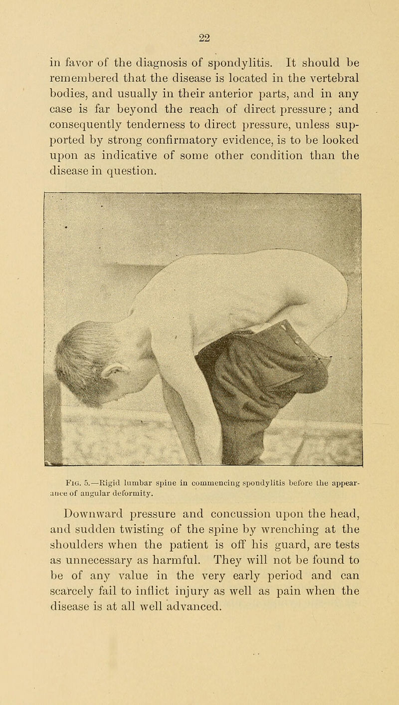 in favor of the diagnosis of spondylitis. It should be remembered that the disease is located in the vertebral bodies, and usually in their anterior parts, and in any case is far beyond the reach of direct pressure; and consequently tenderness to direct pressure, unless sup- ported by strong confirmatory evidence, is to be looked upon as indicative of some other condition than the disease in question. Fig. 5.—Rigid lumbar spiue iu commencing spondylitis before tlie appear- ance of angular deformity. Downward pressure and concussion upon the head, and sudden twisting of the spine by wrenching at the shoulders when the patient is off his guard, are tests as unnecessary as harmful. They will not be found to be of any value in the very early period and can scarcely fail to inflict injury as well as pain when the disease is at all well advanced.