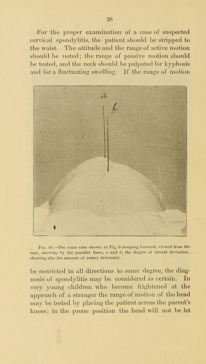 For the proper examination of a case of suspected cervical spondylitis, the patient should be stripped to the waist. The attitude and the range of active motion should be noted; the range of passive motion should be tested, and the neck should be palpated for kyphosis and for a fluctuating swellin;-. If the ranae of motion Fig. 10.—The same case sbowu iii Fig. 9 stooping lorwsird, viewed Iroiu the rear, showing by the parallel lines, a and 6, the degree of lateral deviation ; showing also the amount of rotary deibriuity. be restricted in all directions to some degree, the diag- nosis of spondylitis may be considered as certain. In very young children who become frightened at the approach of a stranger the range of motion of the head may be tested by placing the patient across the parent's knees; in the prone position the head will not be let